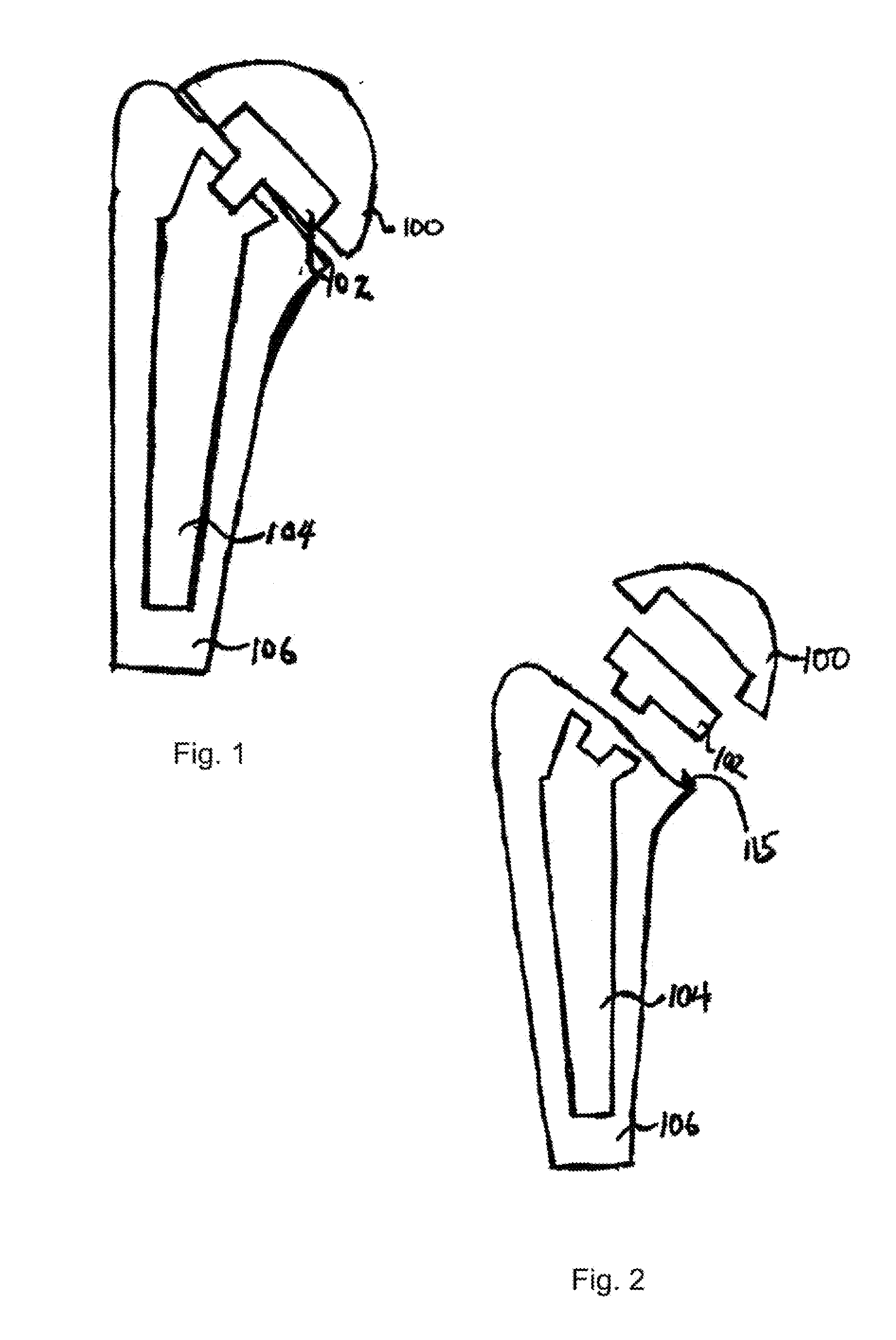 Humeral joint replacement component