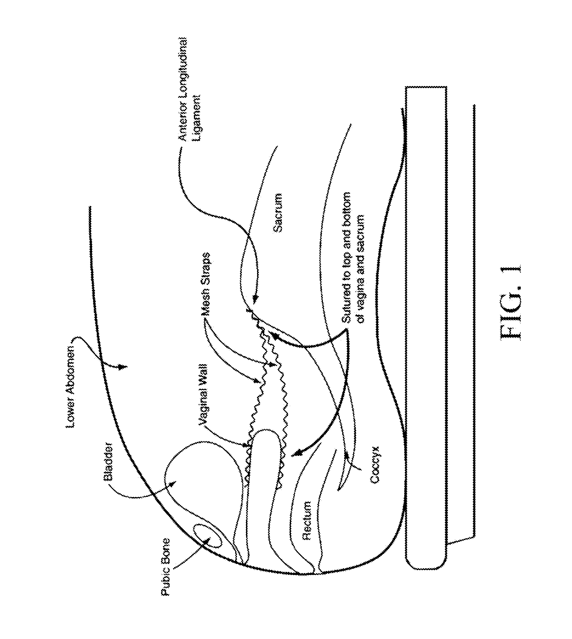 Endoscopic mesh delivery system with integral mesh stabilizer and vaginal probe