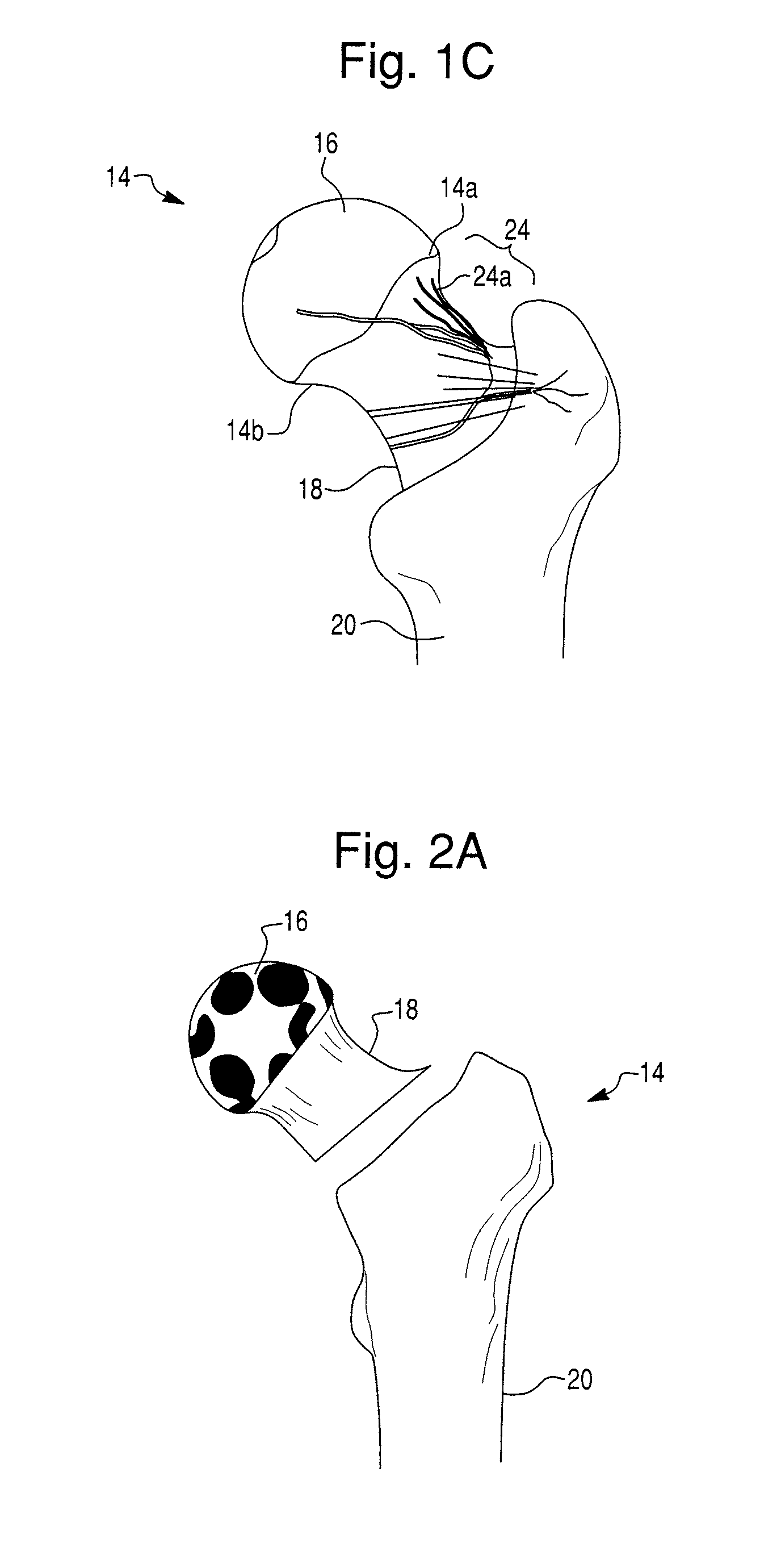 Prosthetic device and system for preparing a bone to receive a prosthetic device