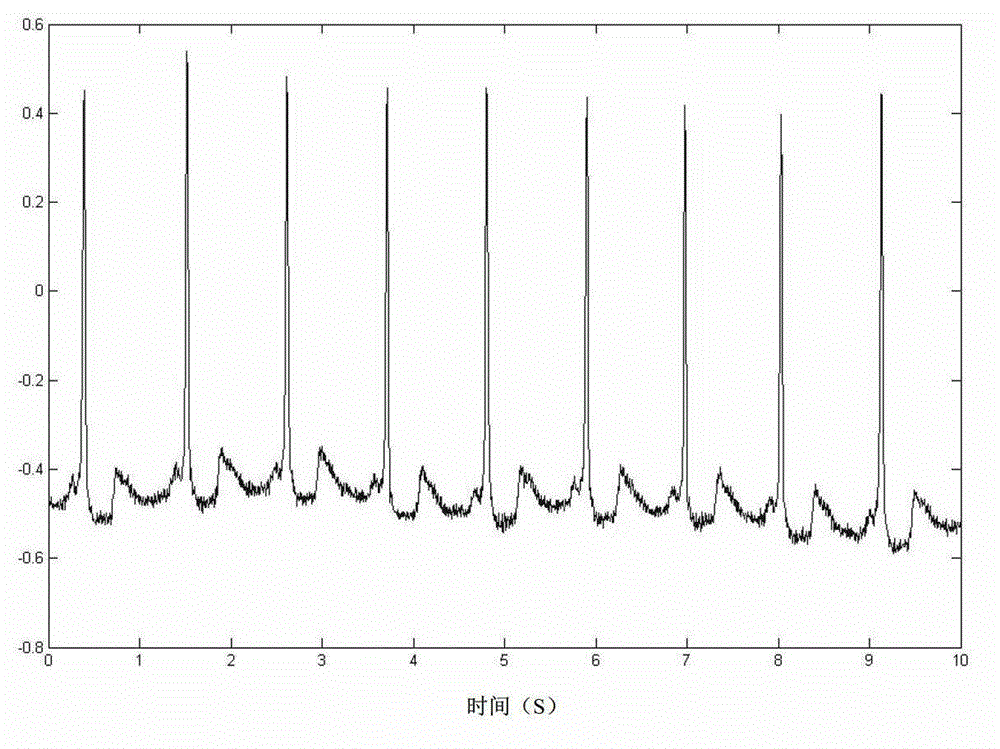 FPGA-based supraventricular tachycardia detection method and system