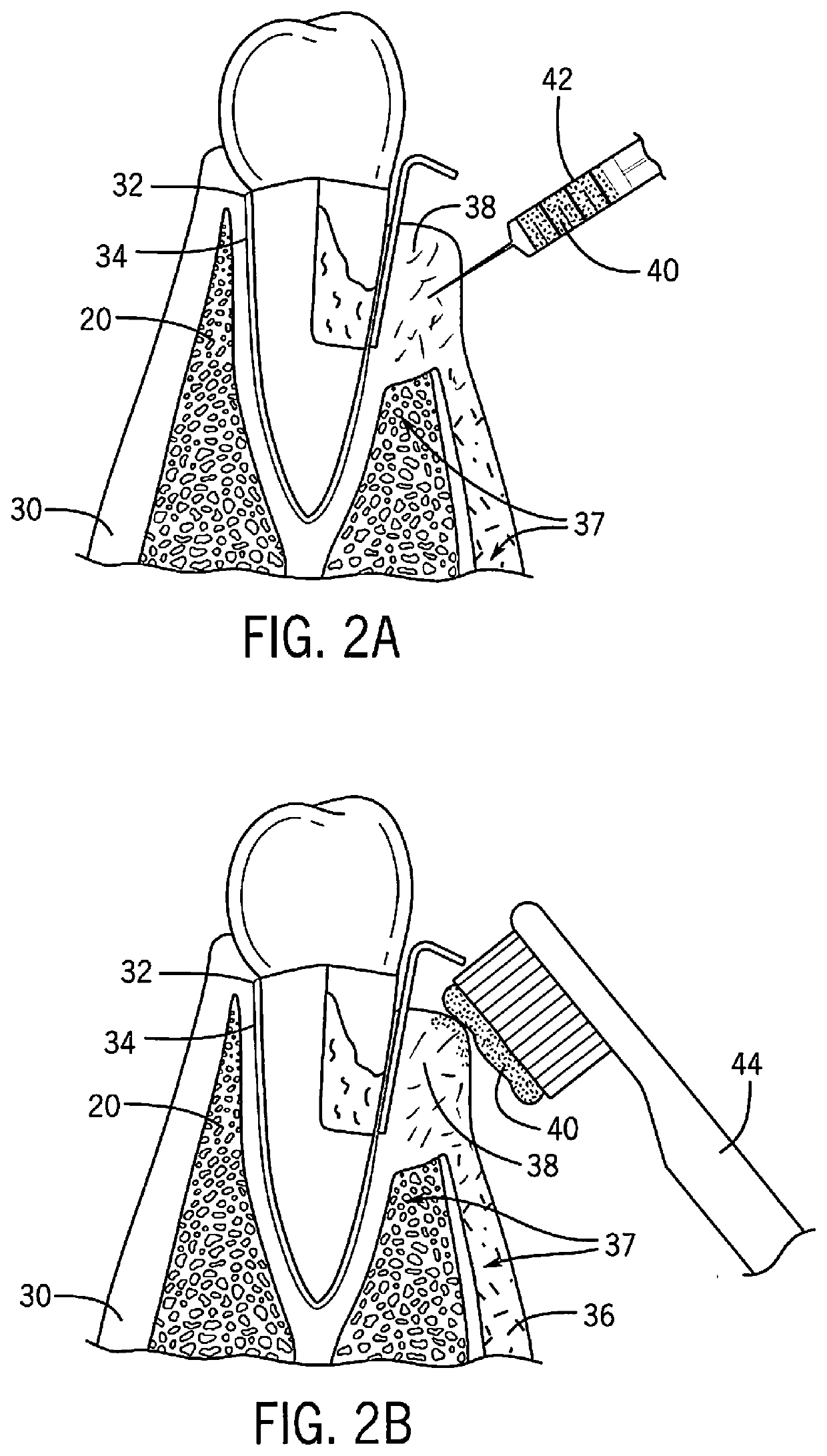 Host modulating and tissue regenerative hydrogel compositions and methods of their delivery to periodontal and peri-implant tissues