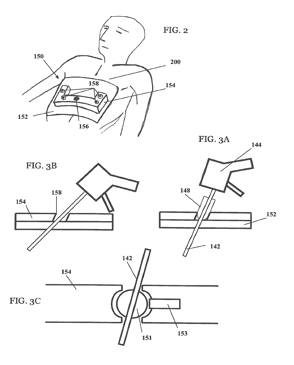 System and method of deploying an elongate unit in a body cavity