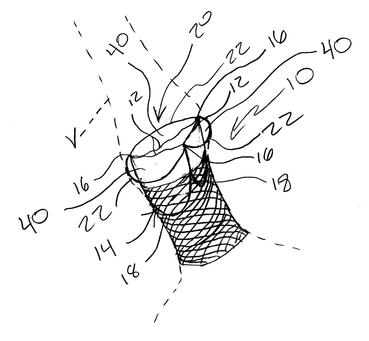 Reinforced Commissural Support Structure