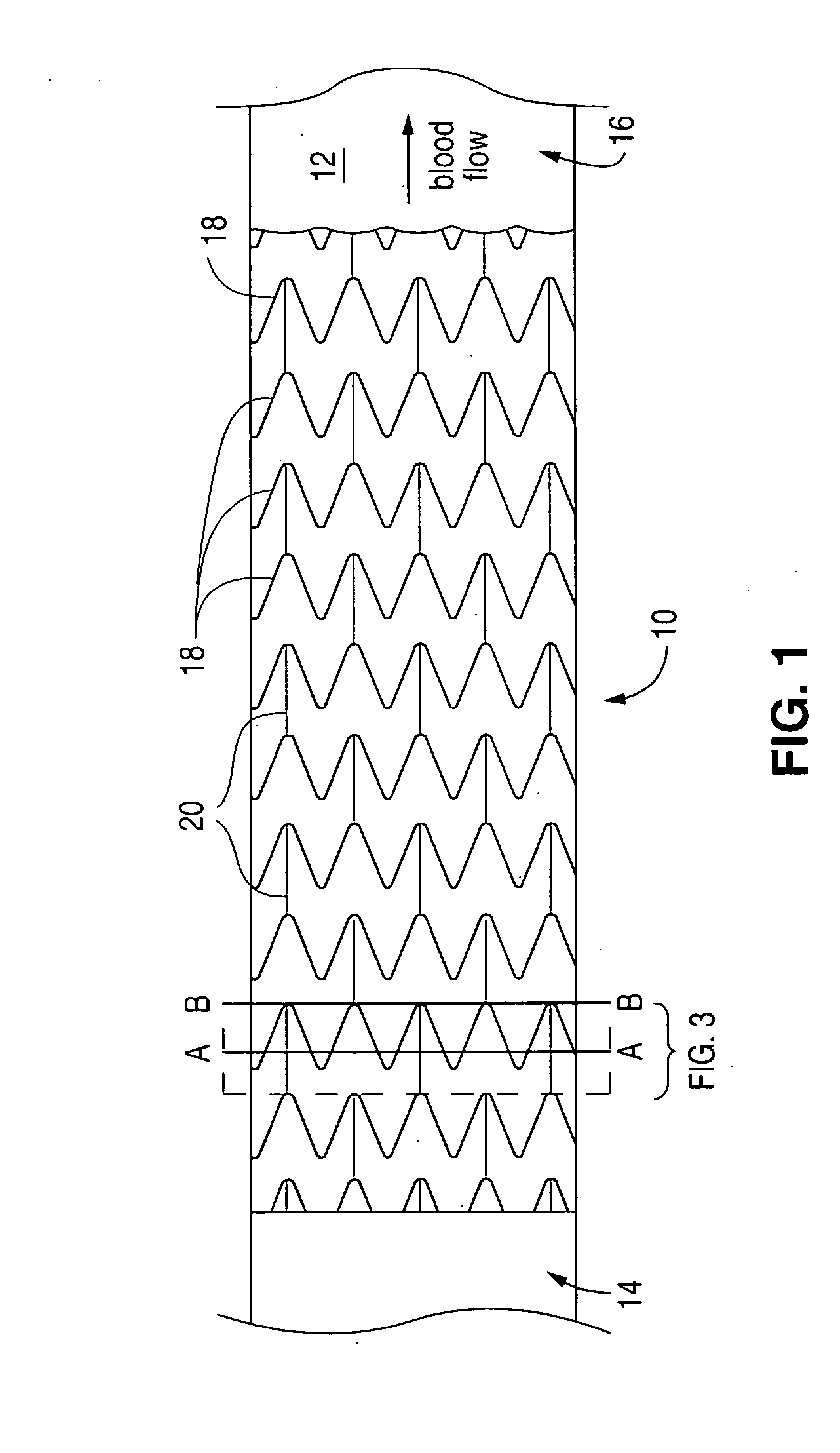 Stent with drug coating