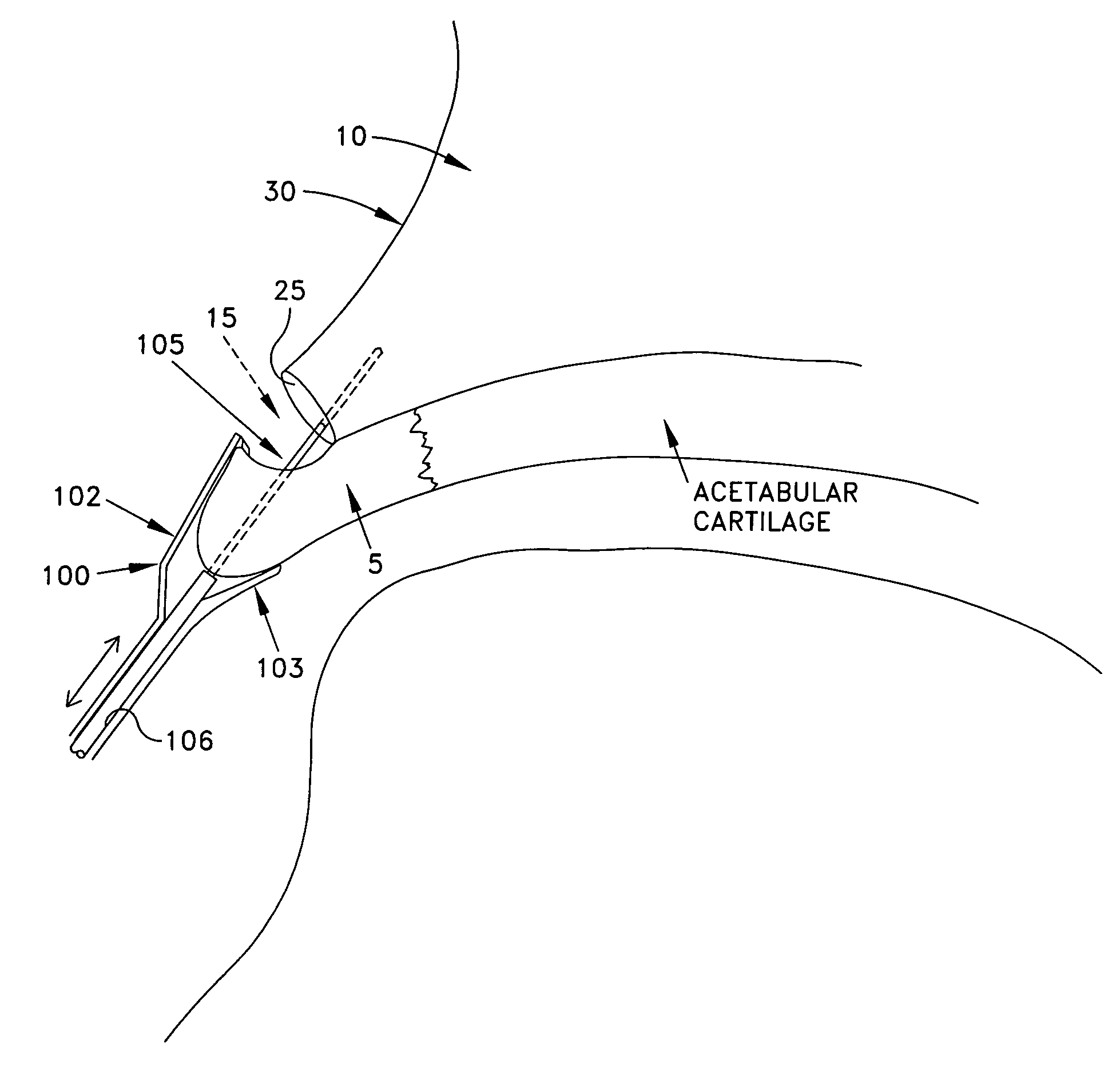 Method and apparatus for re-attaching the labrum of a hip joint