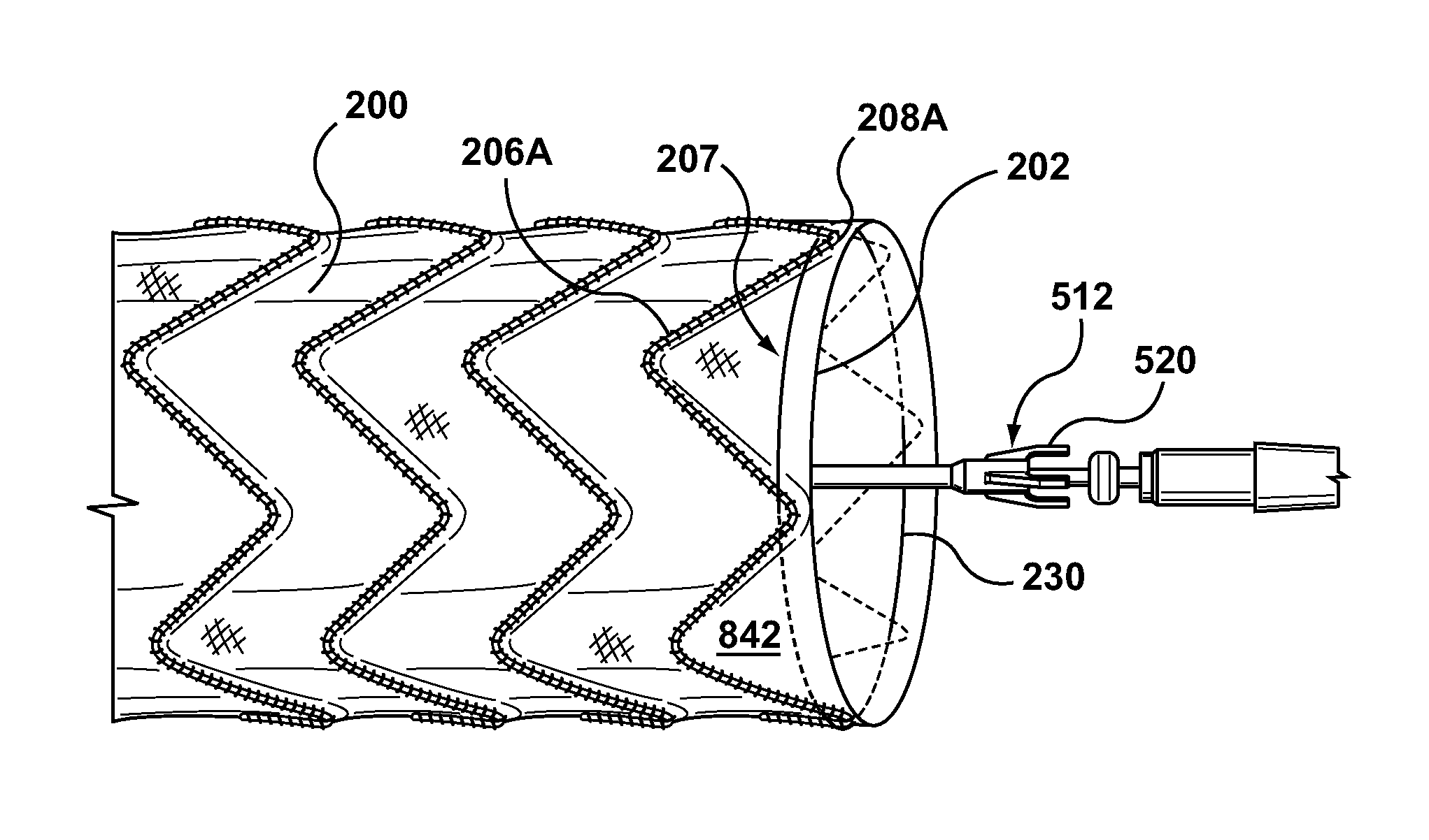 Ring on a closed web stent-graft for use in tip capture