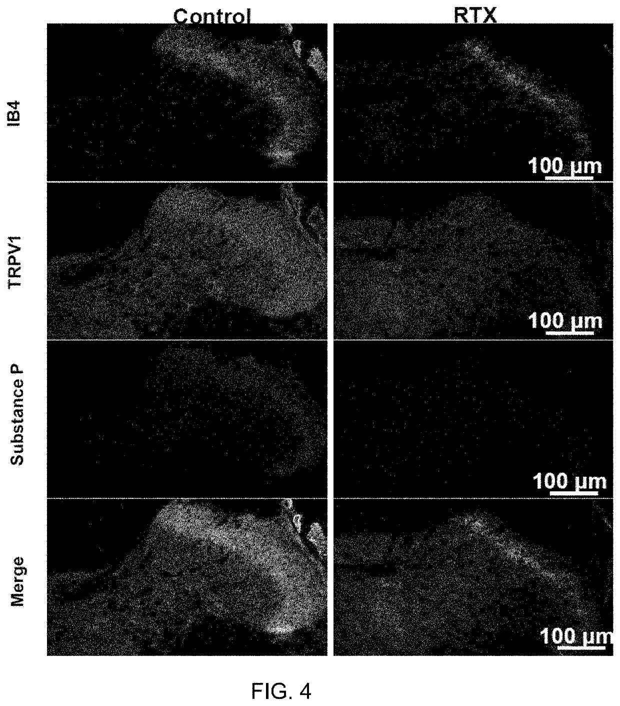 Methods for Administration and Methods for Treating Cardiovascular Diseases with Resiniferatoxin