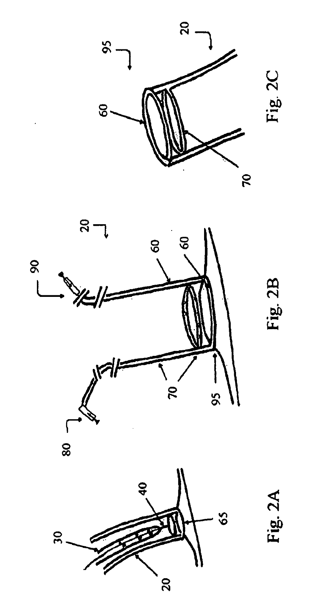 Devices, systems, and methods for promotion of infarct healing and reinforcement of border zone