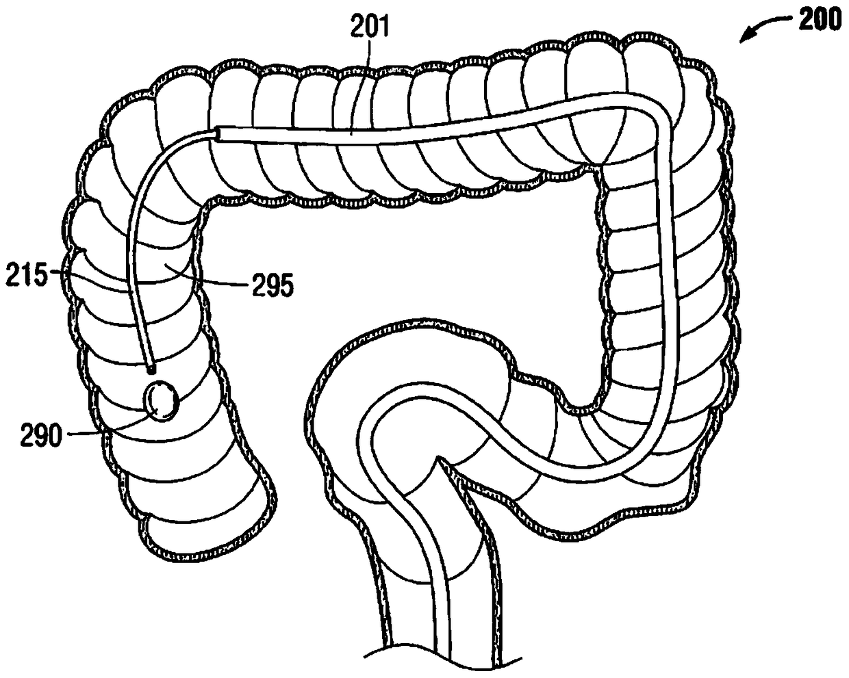 Multilumen Catheter Retractor System for Minimally Invasive Gastrointestinal Surgical Treatment