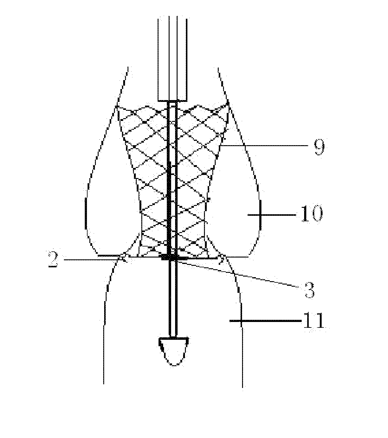 Conveying appliance with valve locating function for use during percutaneous aortic valve replacement operation