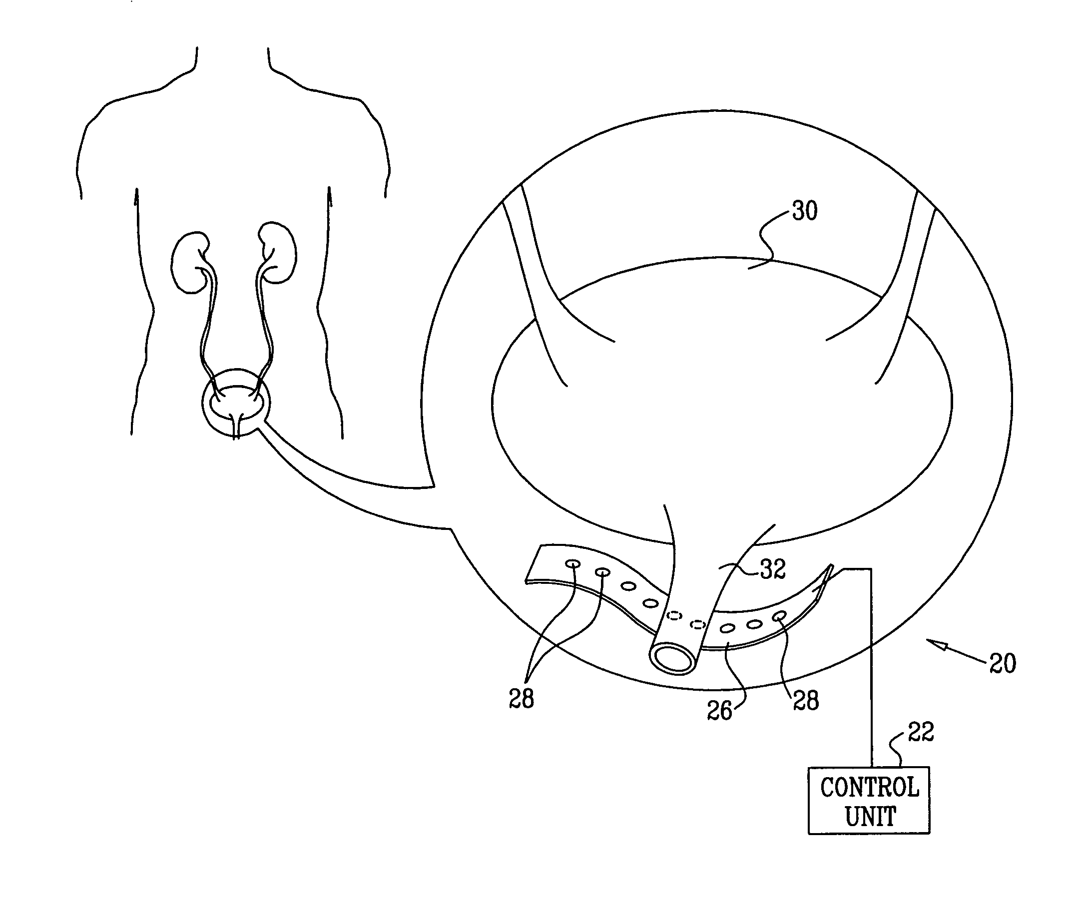 Apparatus for treating stress and urge incontinence