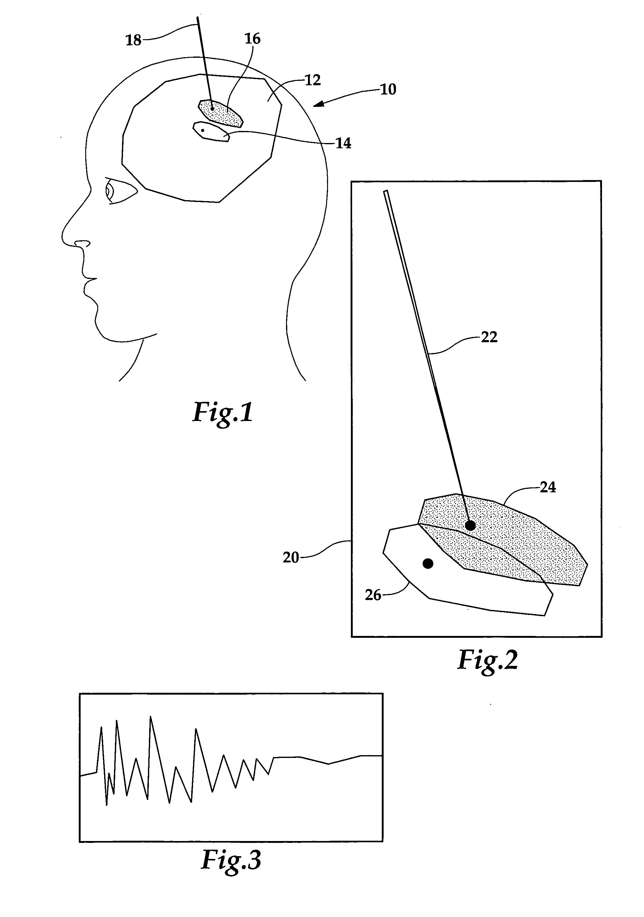 Neurosurgery targeting and delivery system for brain structures