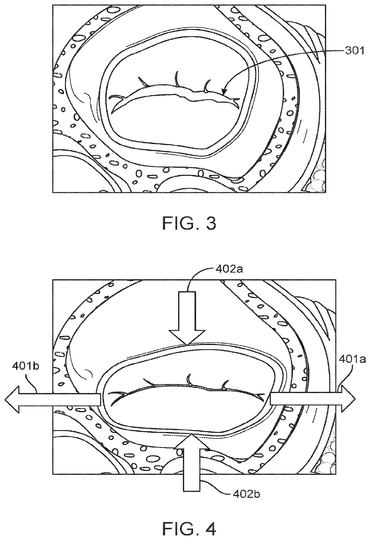 Methods and devices for heart valve repair