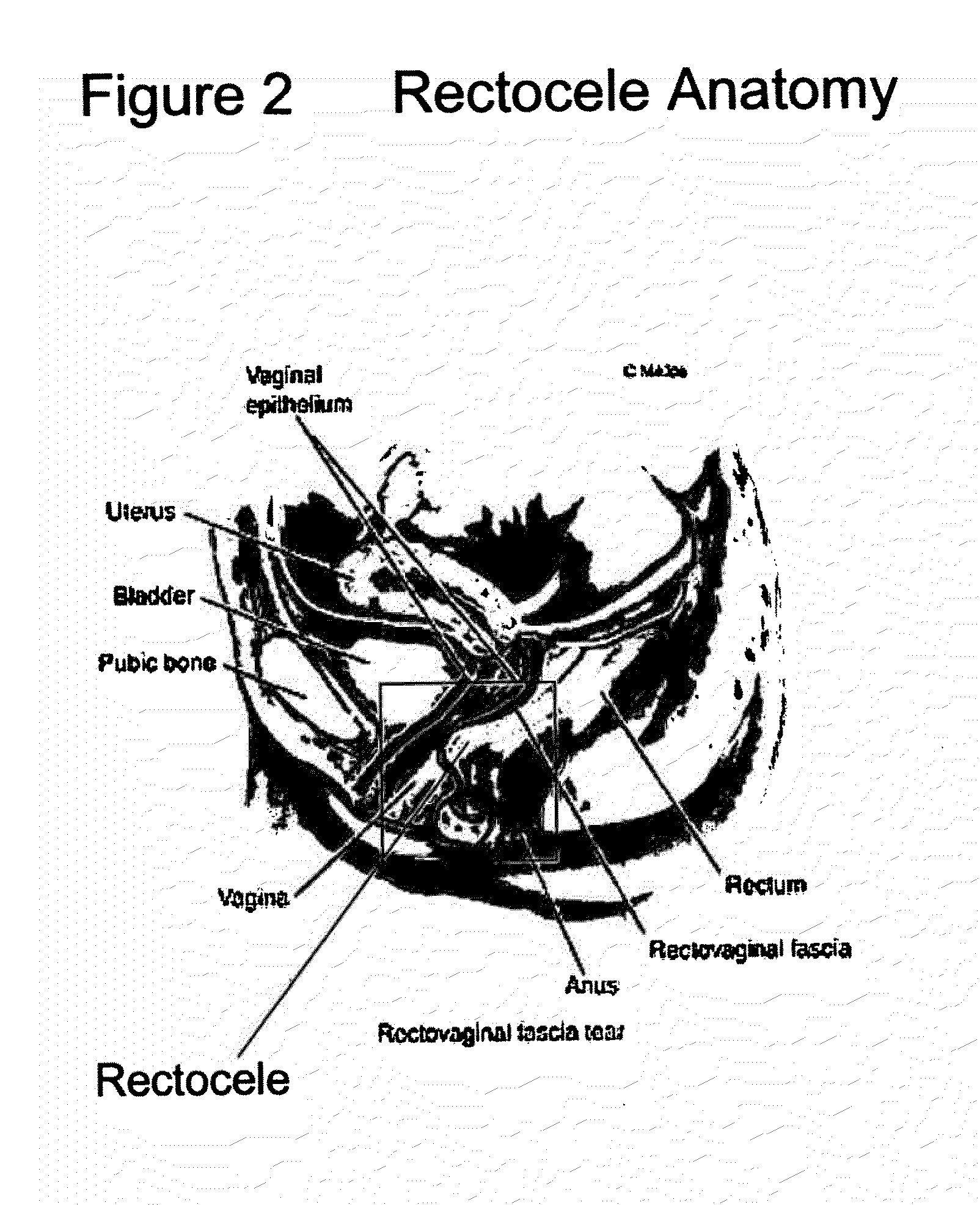 Surgical adhesive and uses therefore