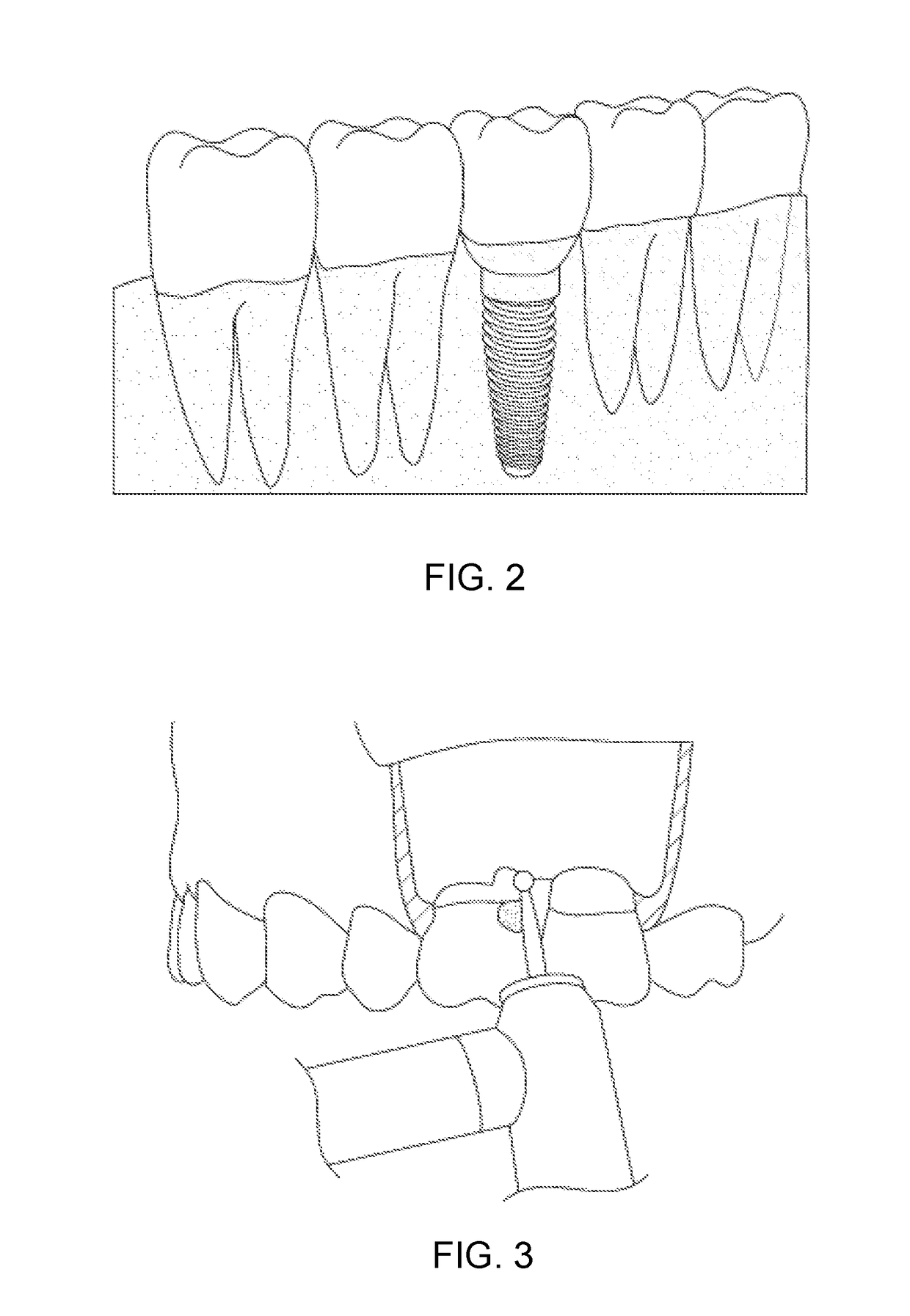 Augmented Reality System and Method for Implementing Augmented Reality for Dental Surgery