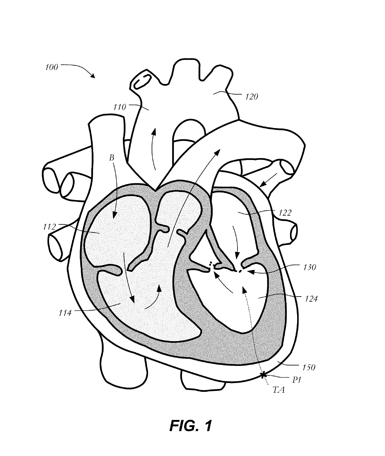 Mitral heart valve replacement