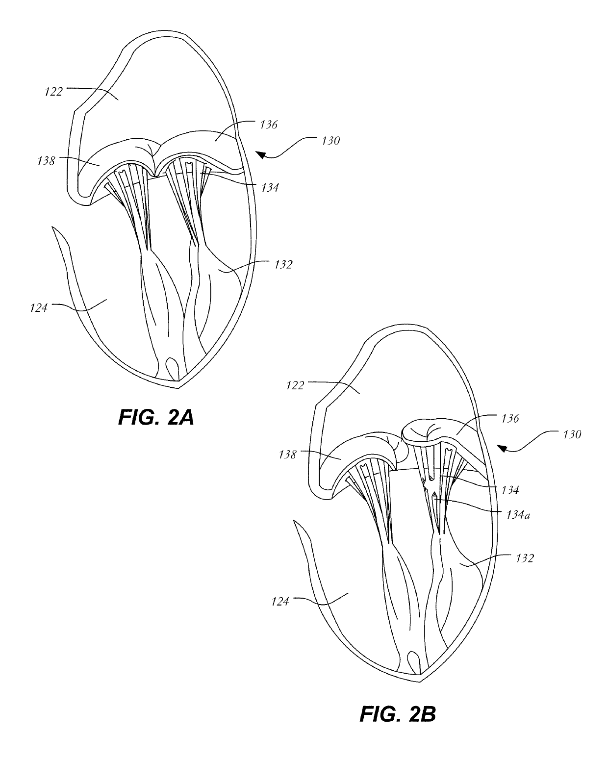 Mitral heart valve replacement