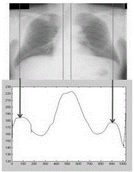 X-ray chest radiography lung segmentation method and device