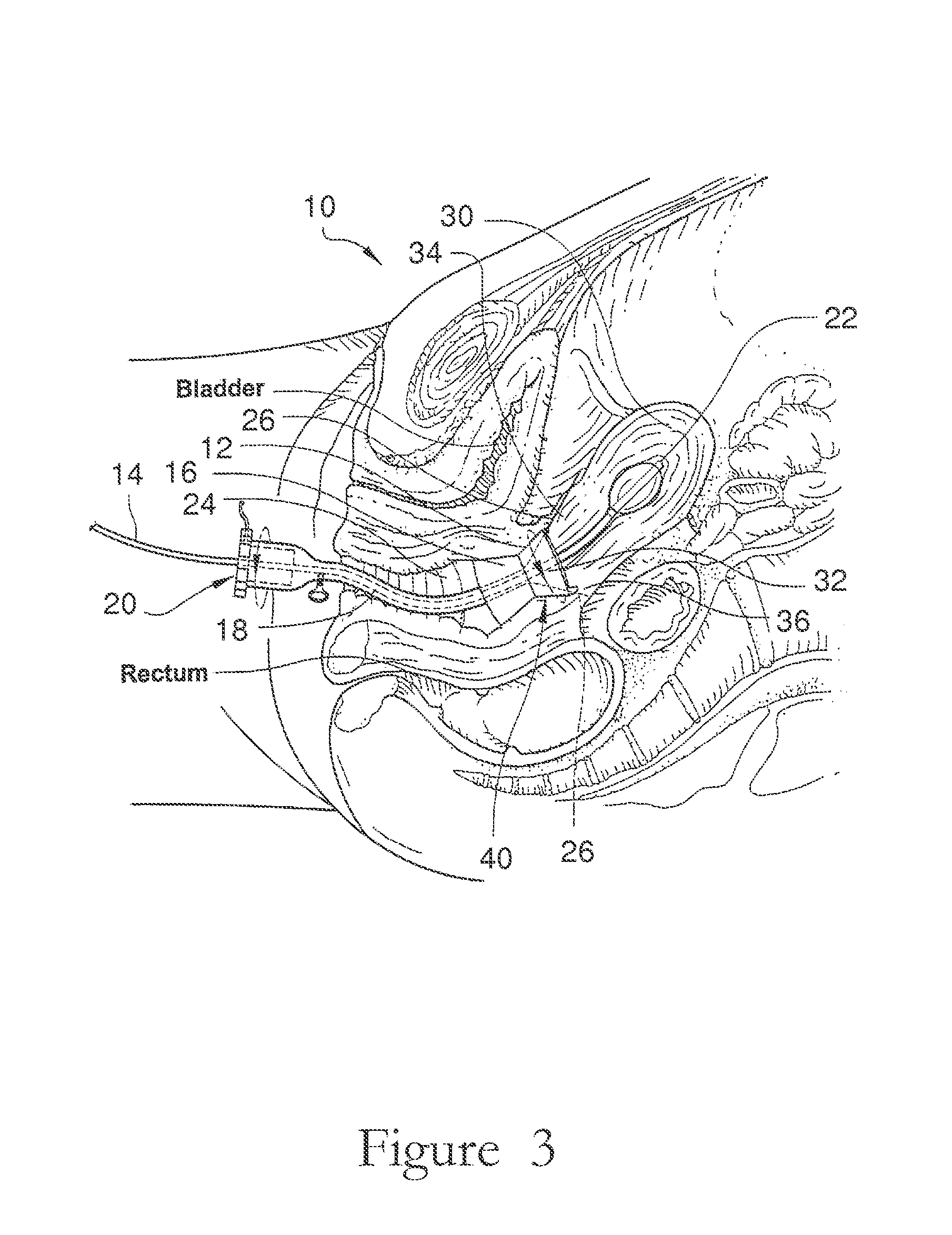 Electrosurgical element and uterine manipulator for total laparoscopic hysterectomy