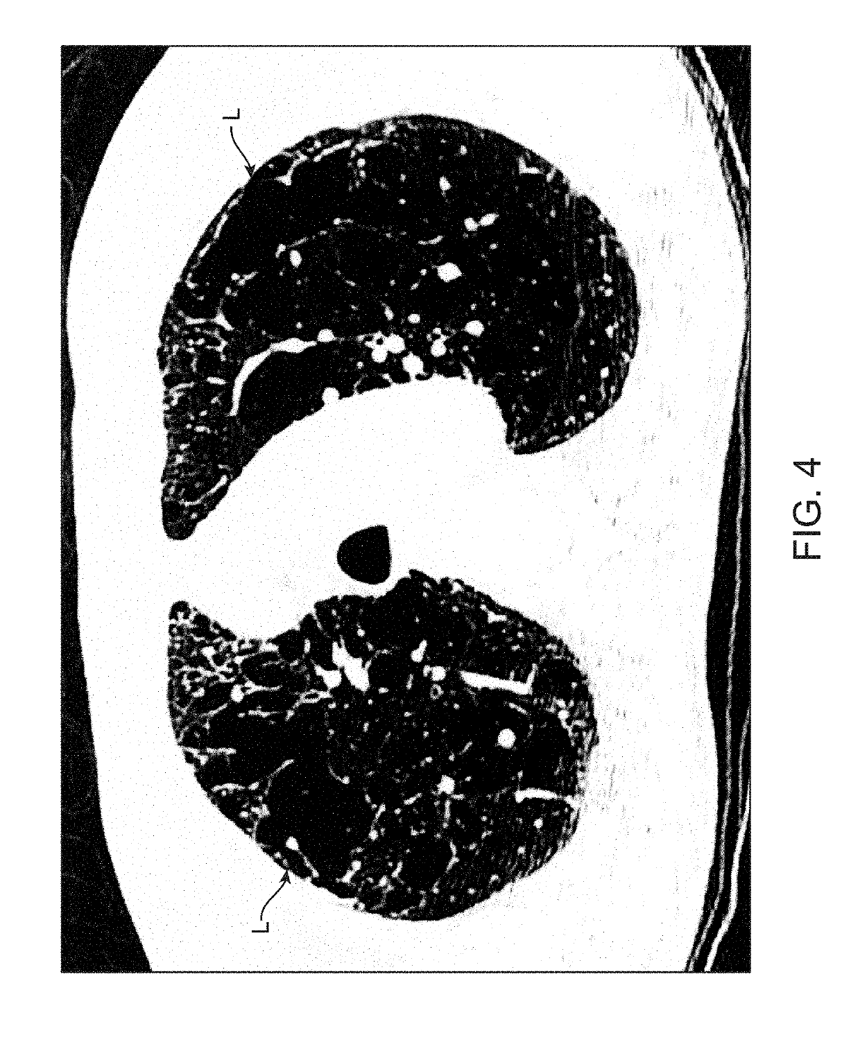 Devices, treatments and methods to restore tissue elastic recoil