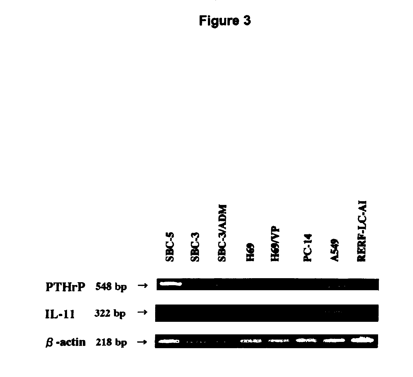 Non-human animal exhibiting bone metastasis of tumor cells and method of screening for bone metastasis inhibitors