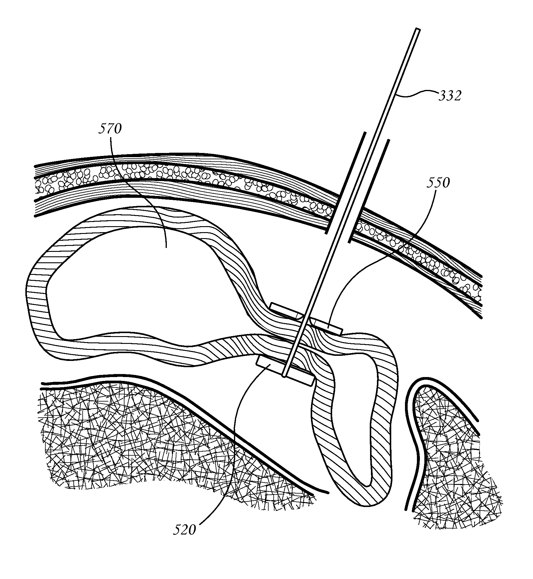 Extragastric Balloon