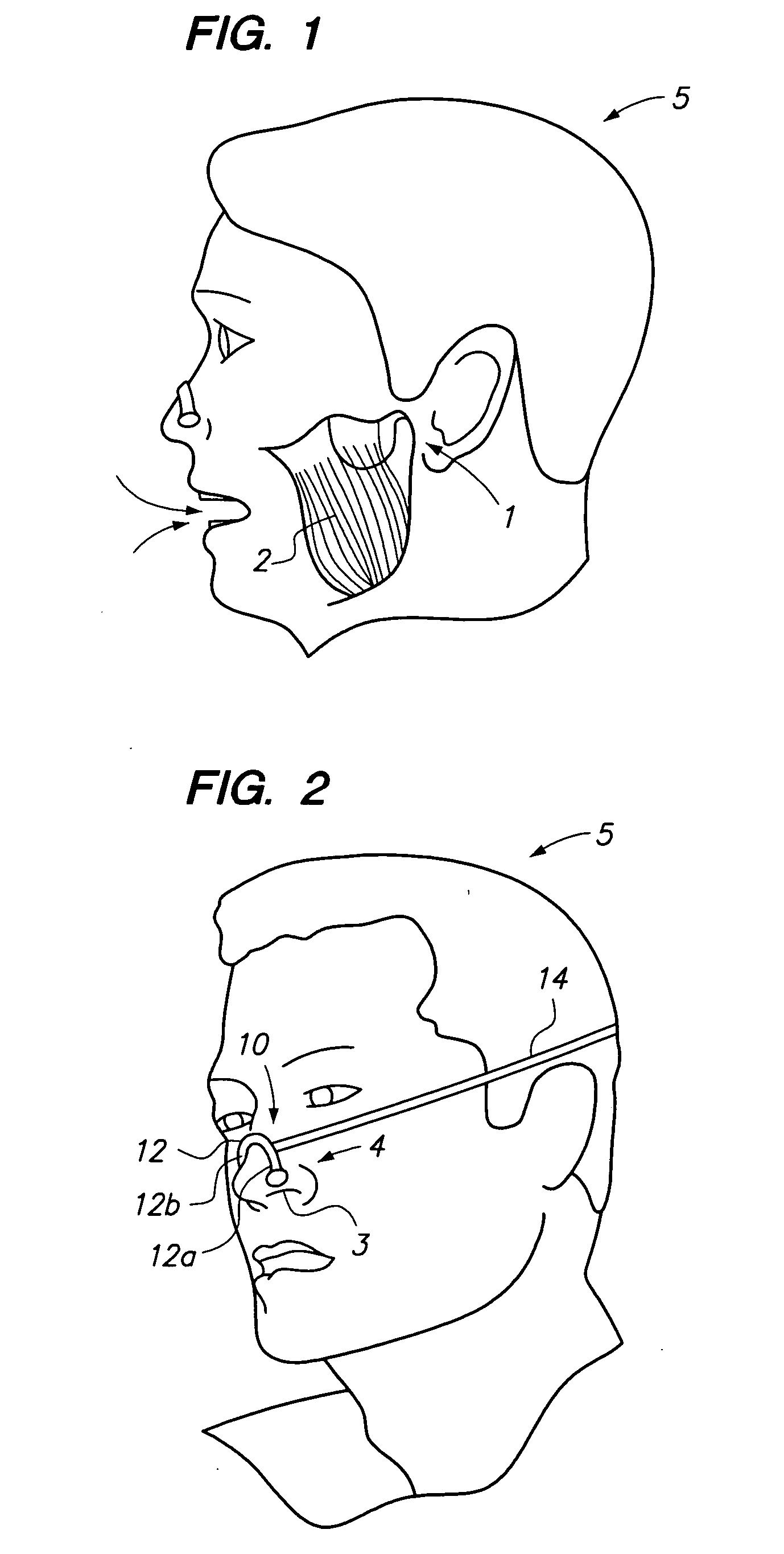 Method and device for treating bruxism while sleeping