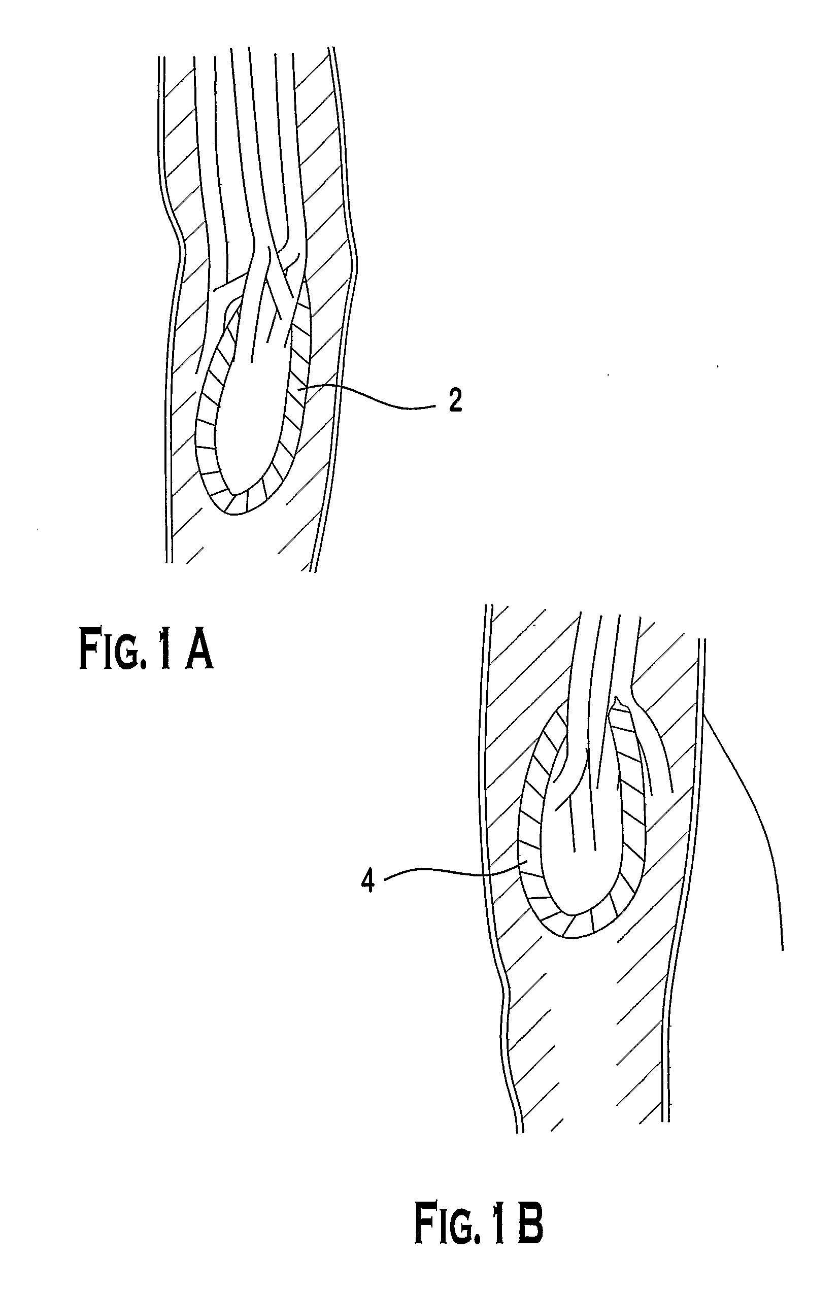 Self-Sealing Ptfe Graft with Kink Resistance