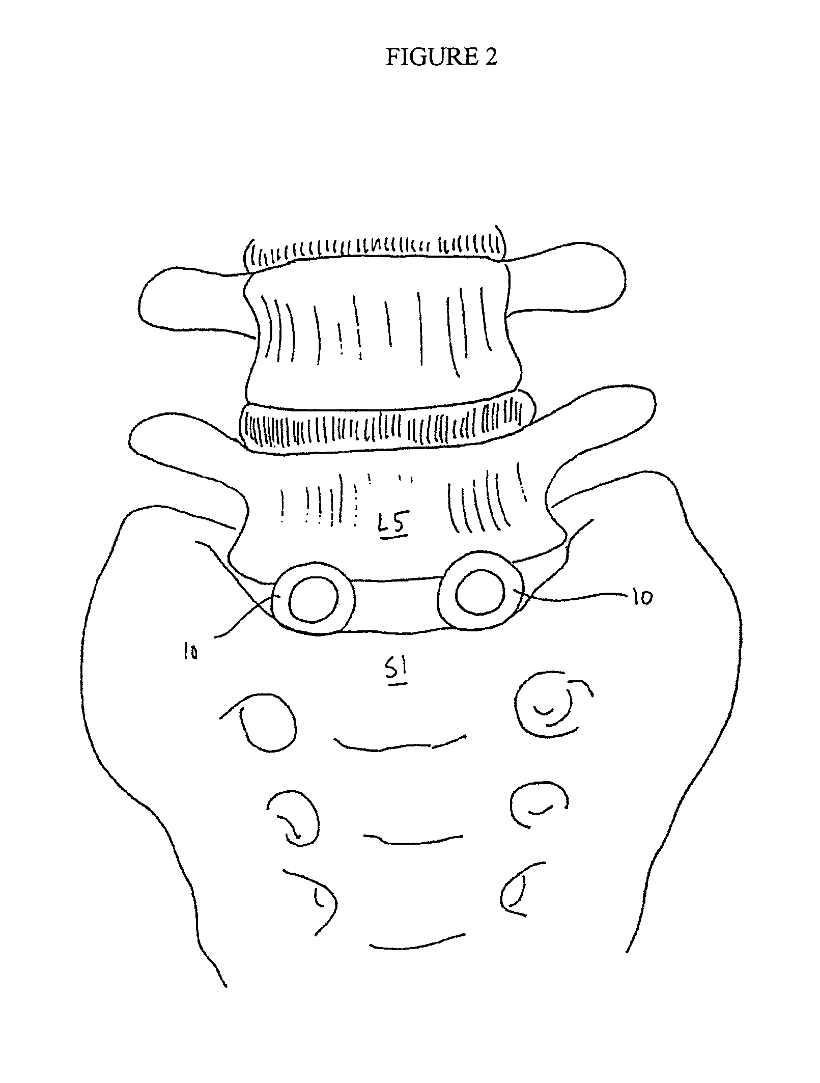 Spinal baseplates with ball joint coupling and a retaining member