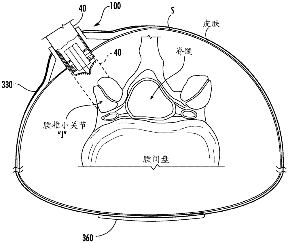 Surgical tools with positional components