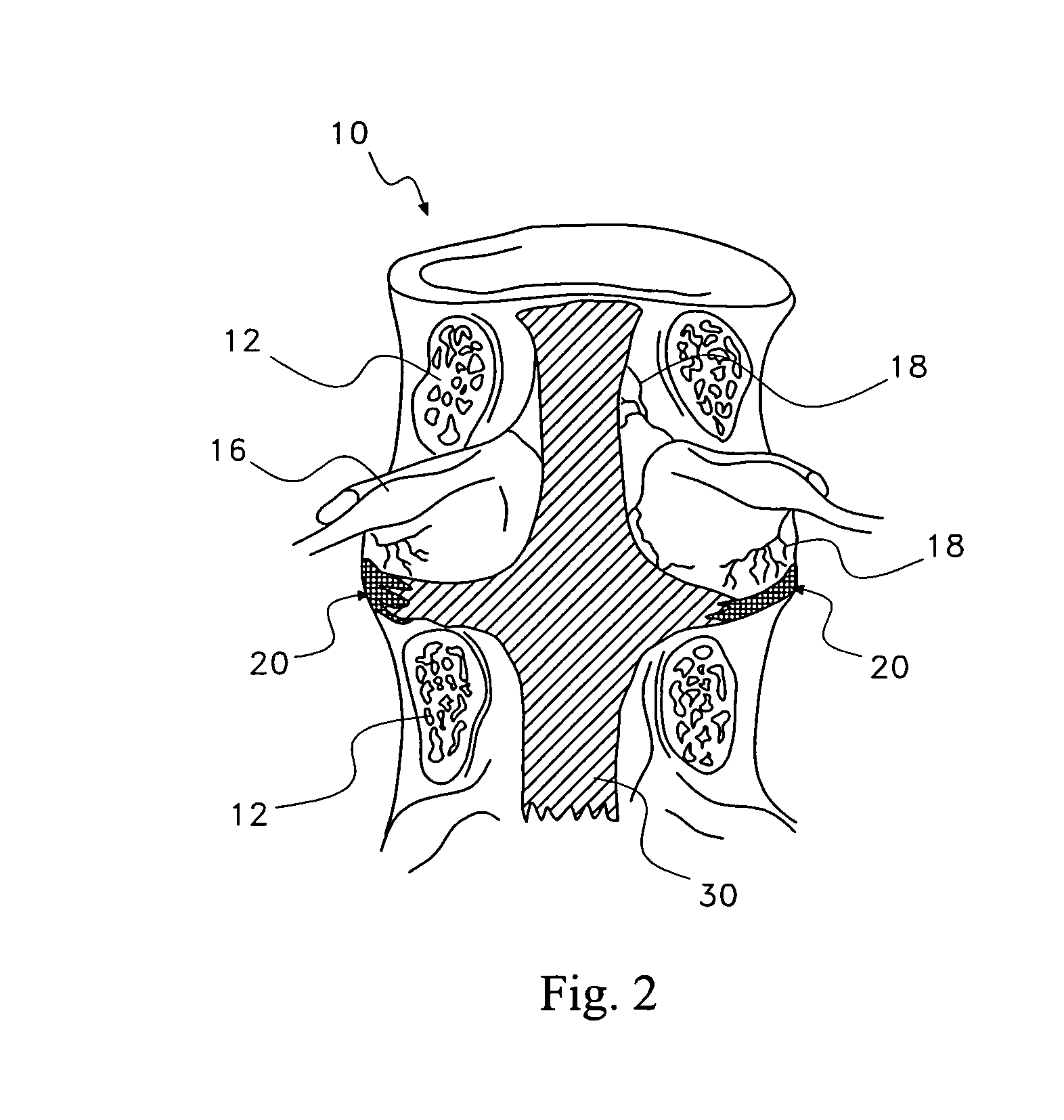 Pharmaceutical removal of neuronal extensions from a degenerating disc