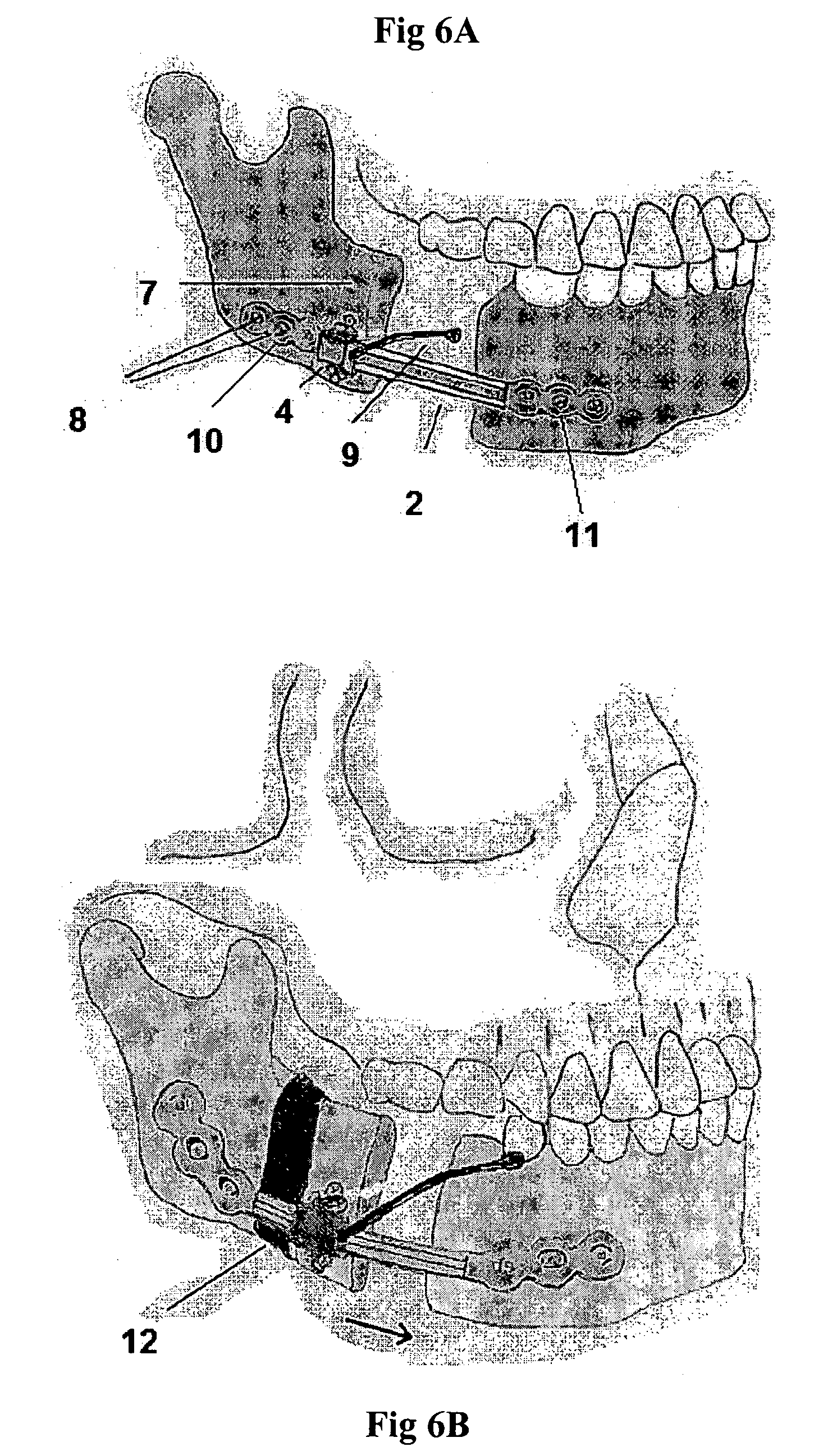 Mandibular bone transport reconstruction plate