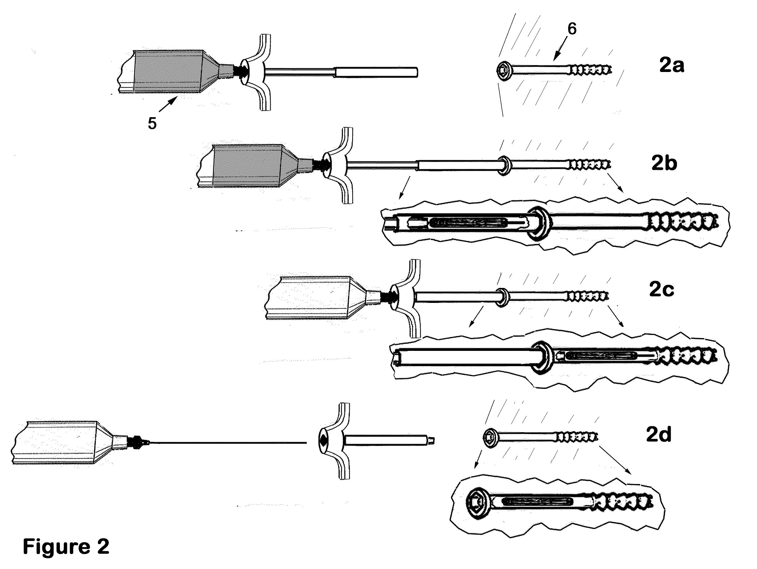 Therapeutic material delivery system for tissue voids and cannulated implants