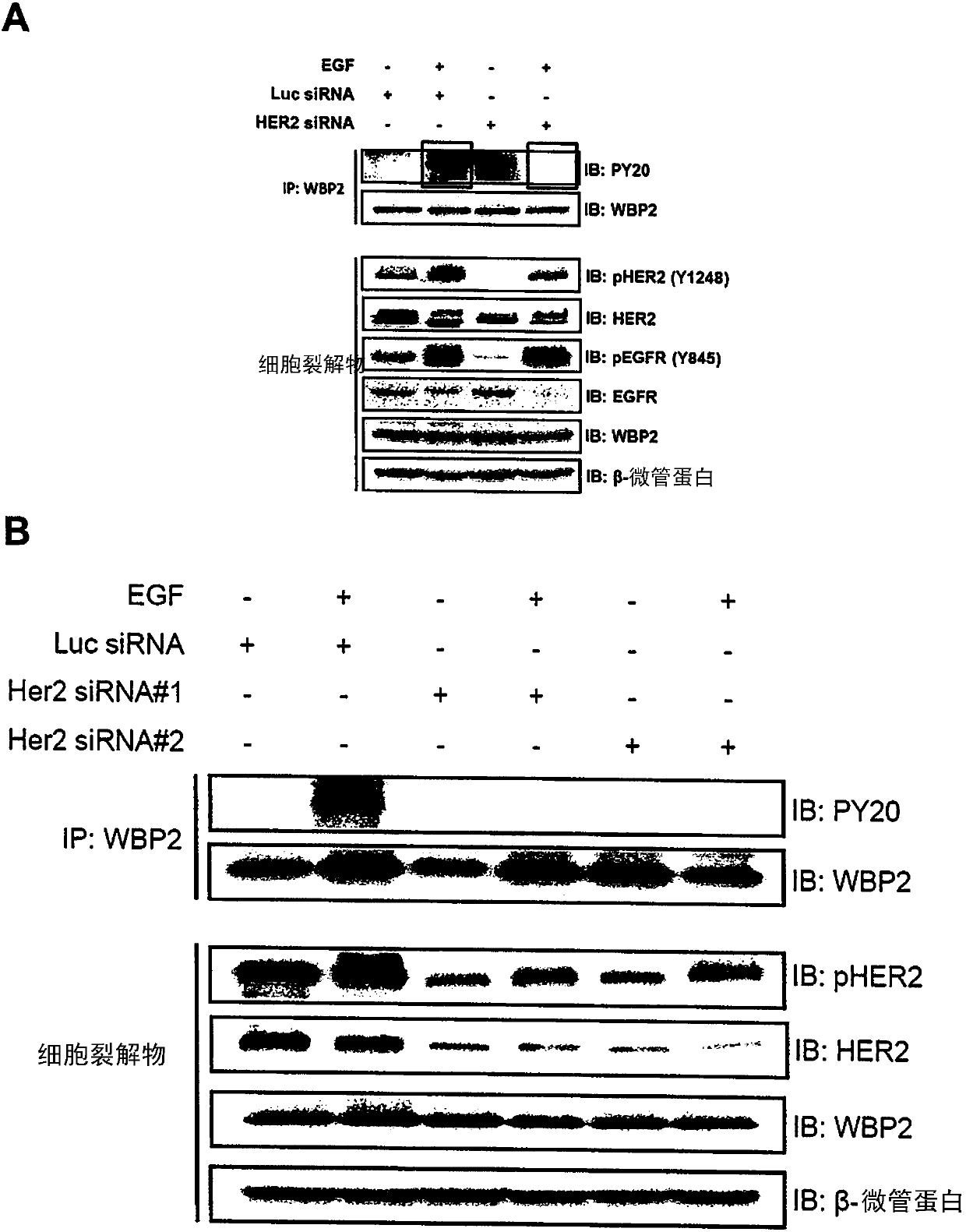 Wbp2 as a co-prognostic factor with her2 for stratification of patients for treatment