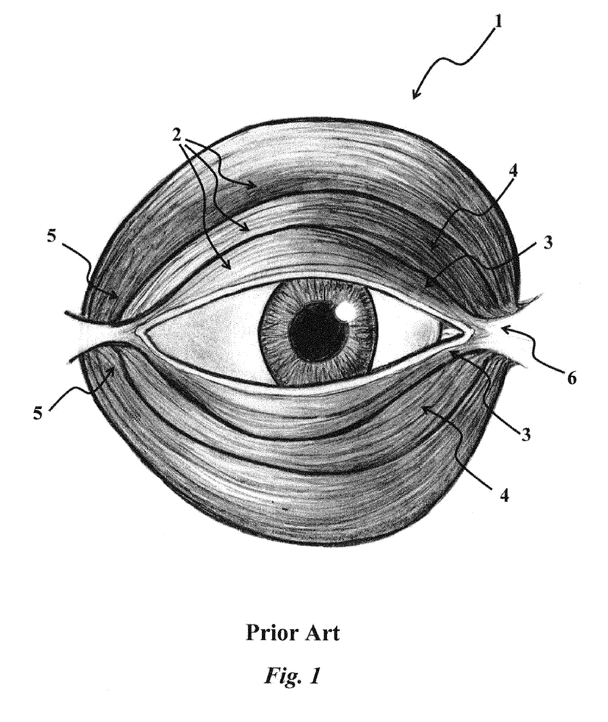 Medial orbicularis flap canthoplasty with orbicularisorrhaphy