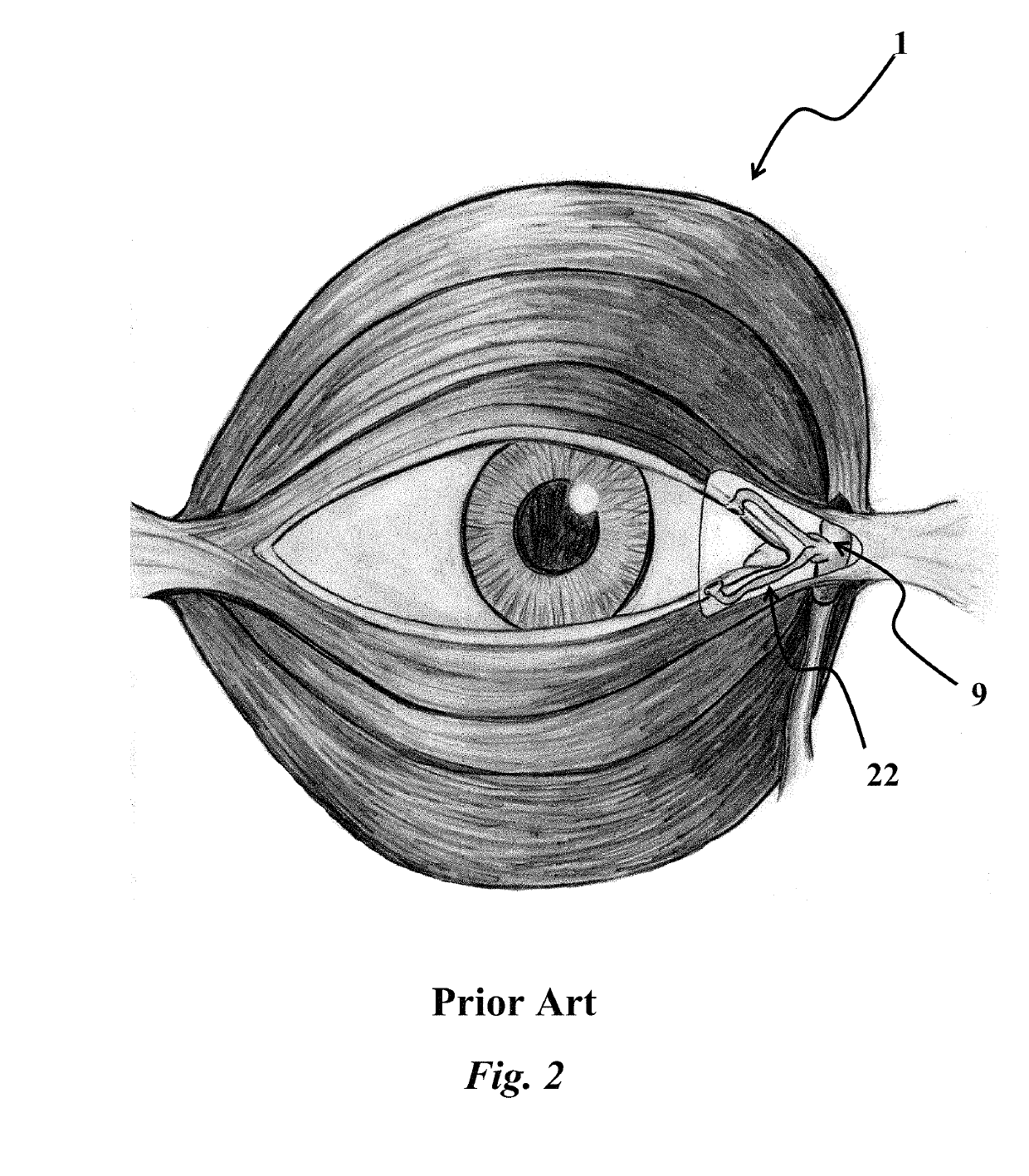 Medial orbicularis flap canthoplasty with orbicularisorrhaphy