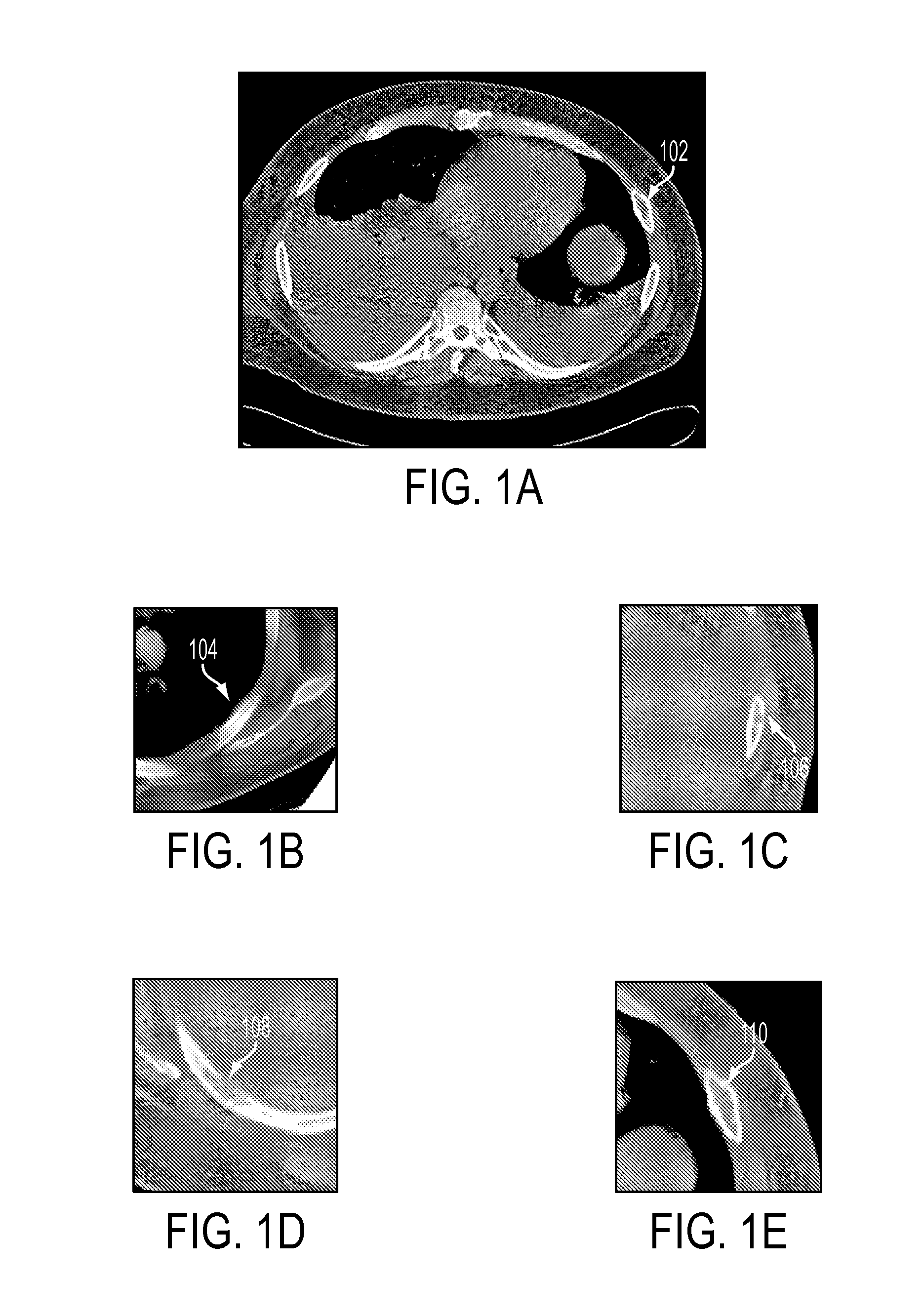 System and Method for Automatic Detection of Rib Metastasis in Computed Tomography Volume