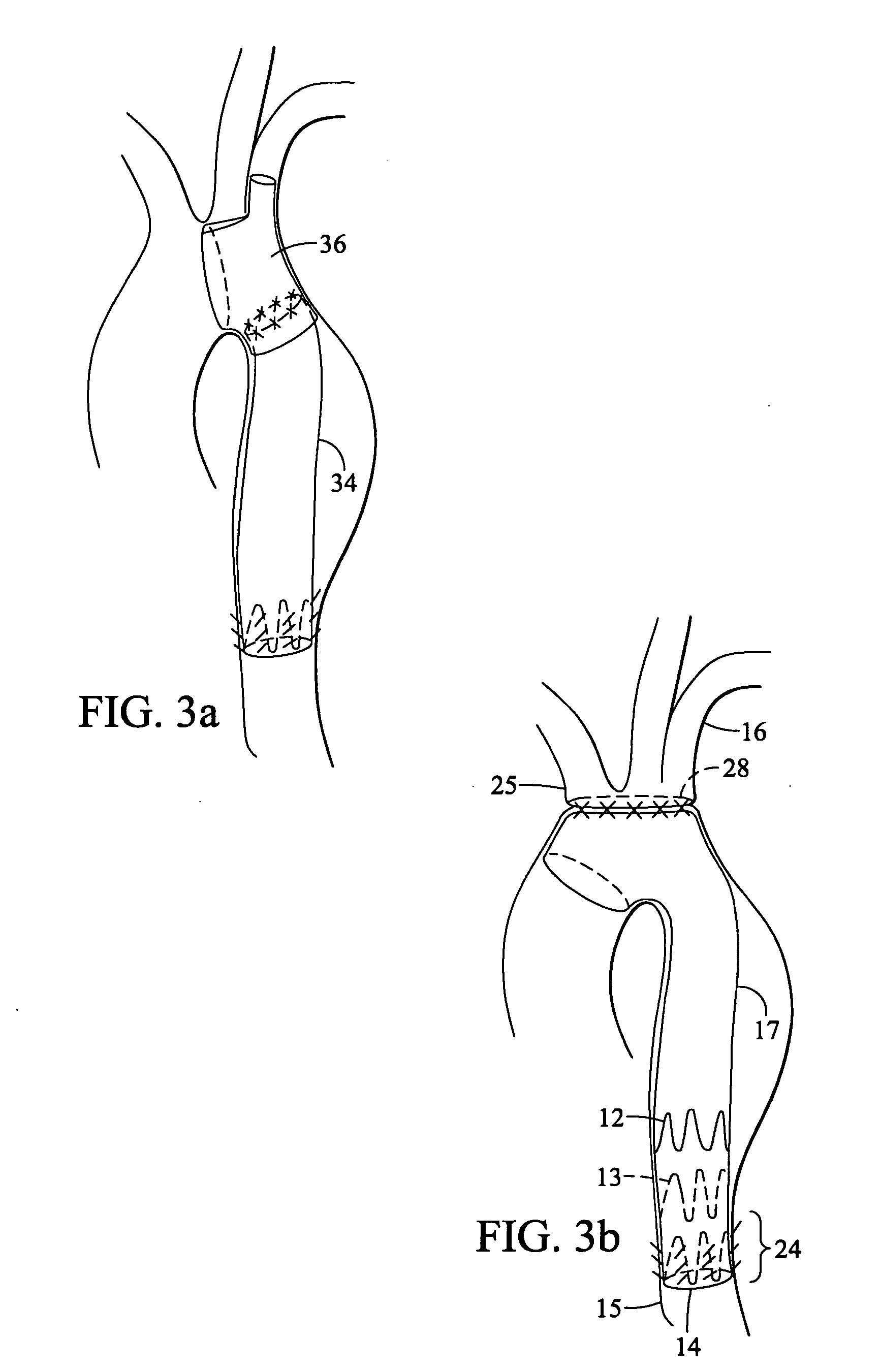 Tapered and distally stented elephant trunk stent graft