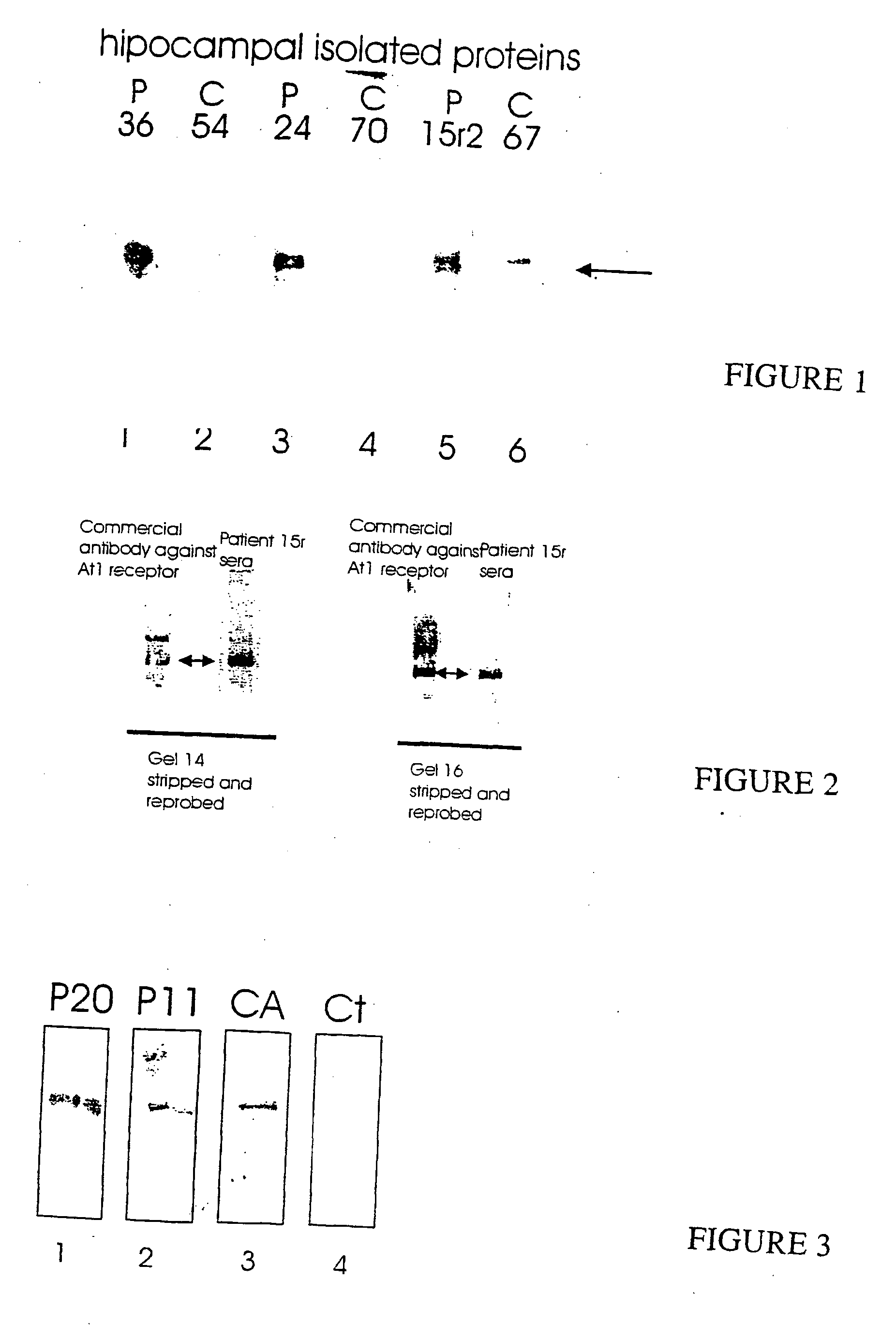 Autoimmunity to angiotensin at1 receptors in schizophrenia