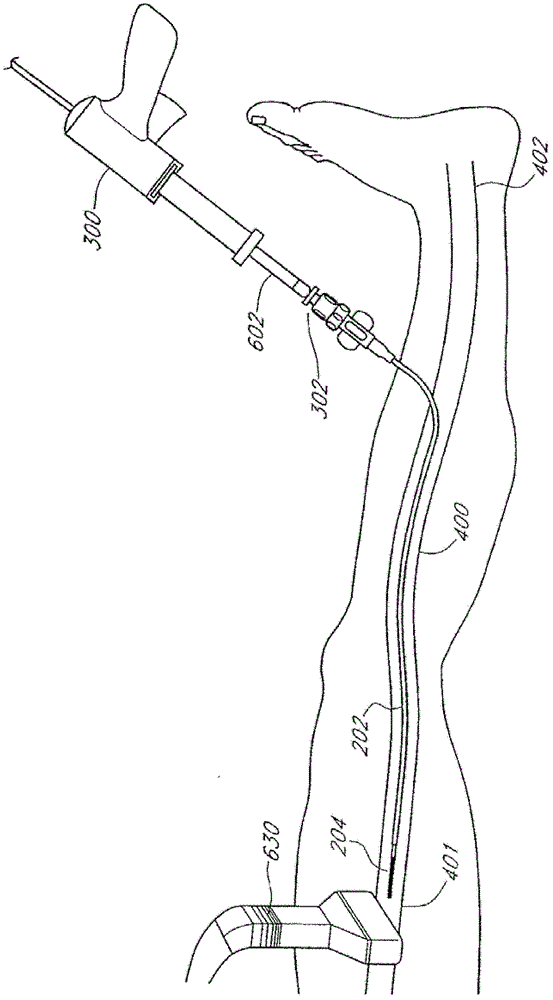 Method and device for treating venous occlusion in venous insufficiency