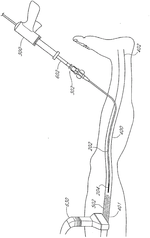 Method and device for treating venous occlusion in venous insufficiency