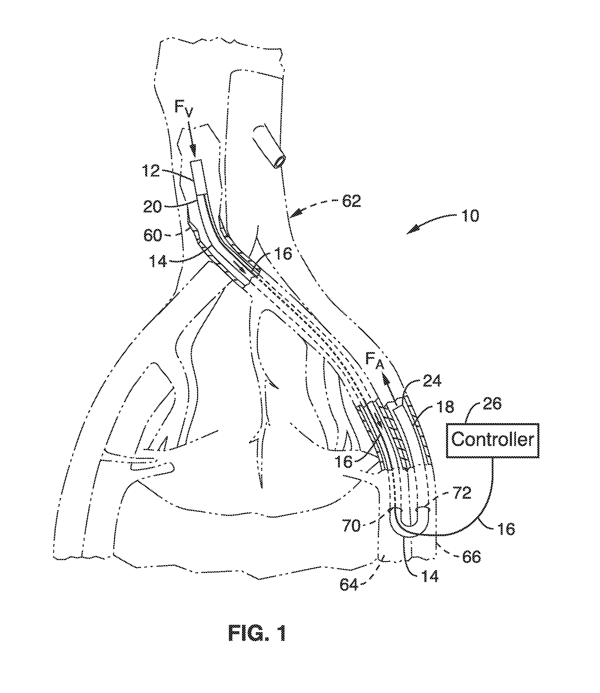 Methods and devices for treating heart failure