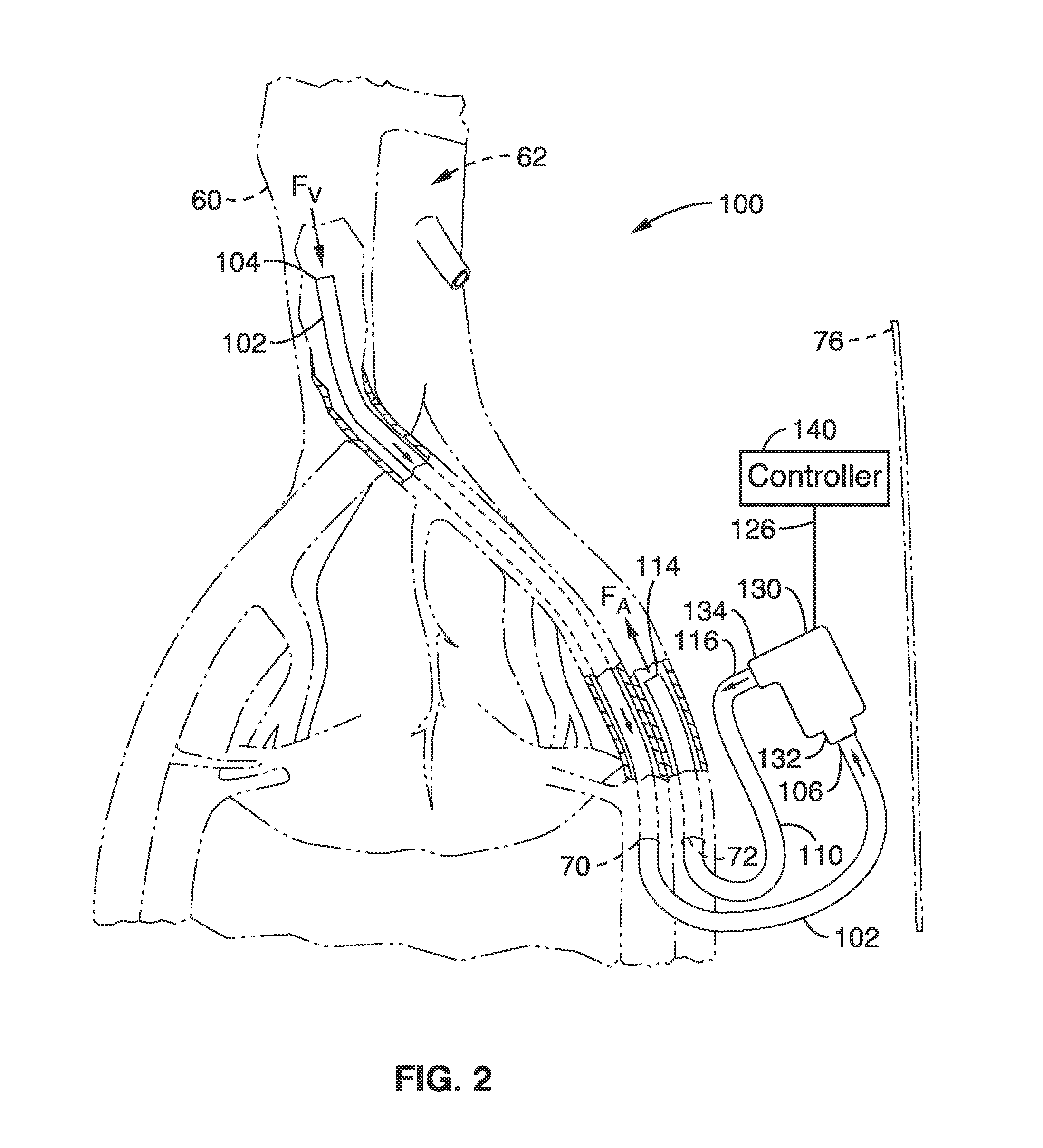 Methods and devices for treating heart failure