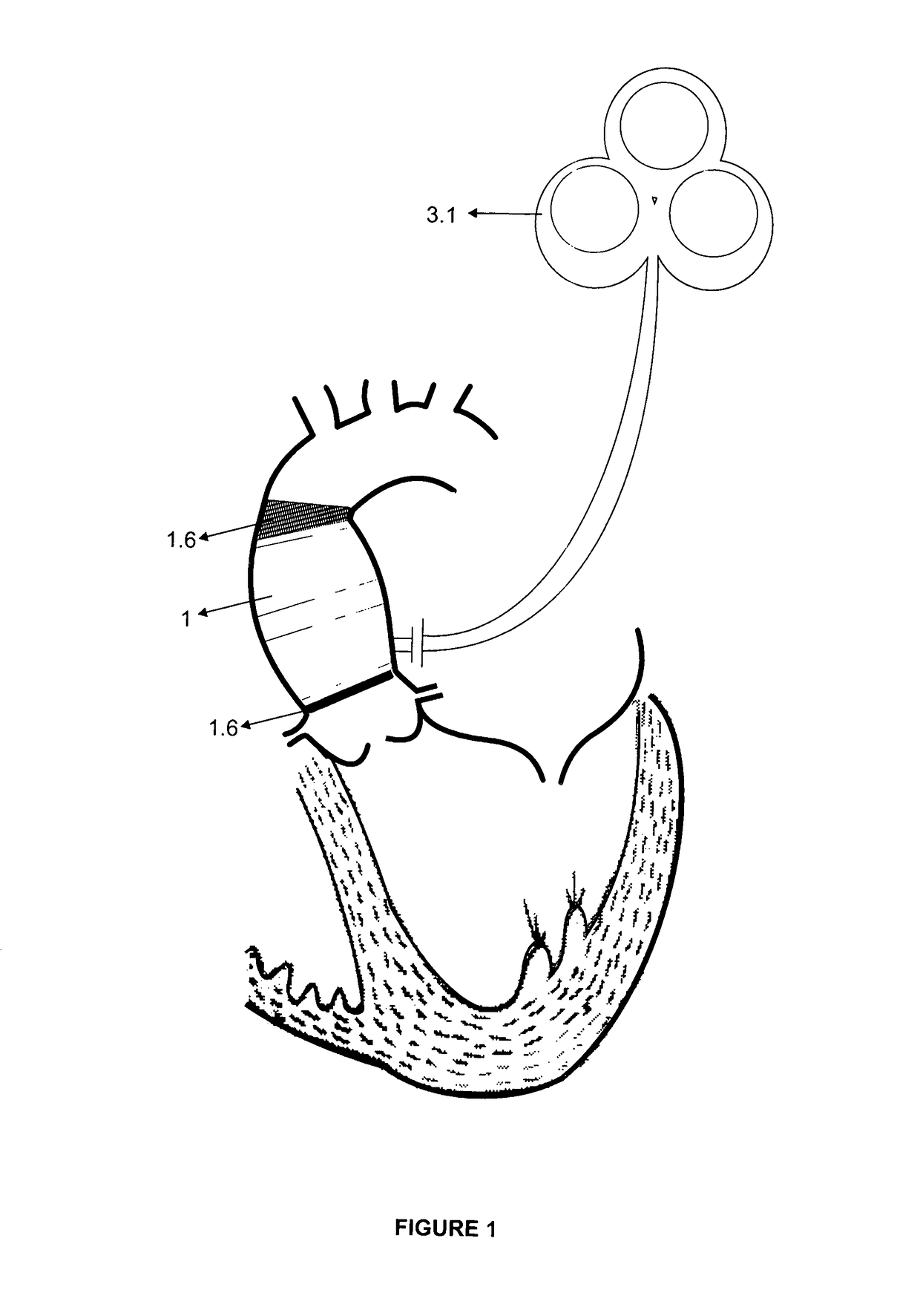 Endovascular permanent heart assist device