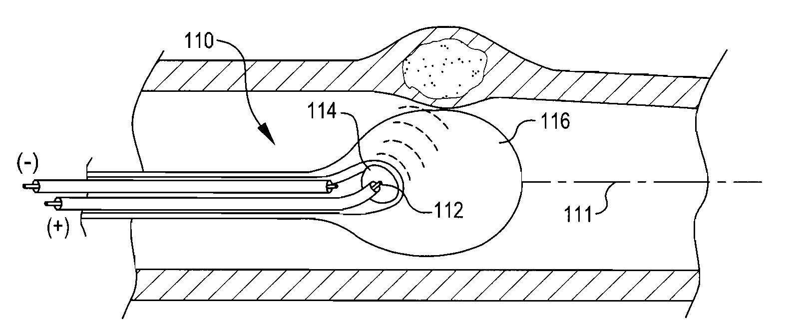 Shockwave balloon catheter system