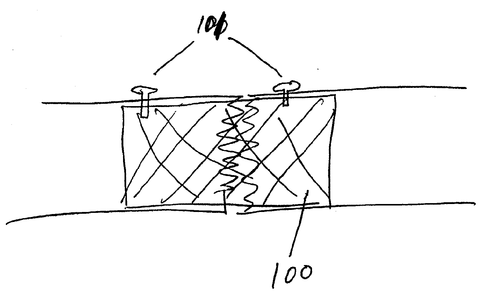 Methods and devices for treatment of bone fractures