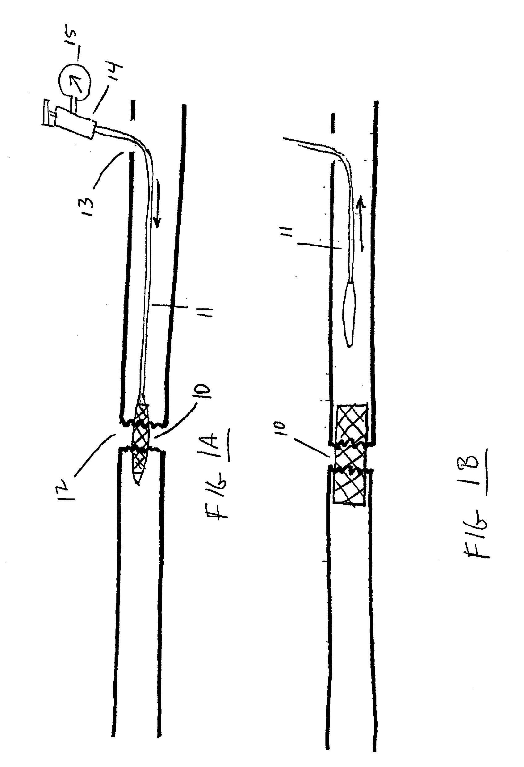 Methods and devices for treatment of bone fractures