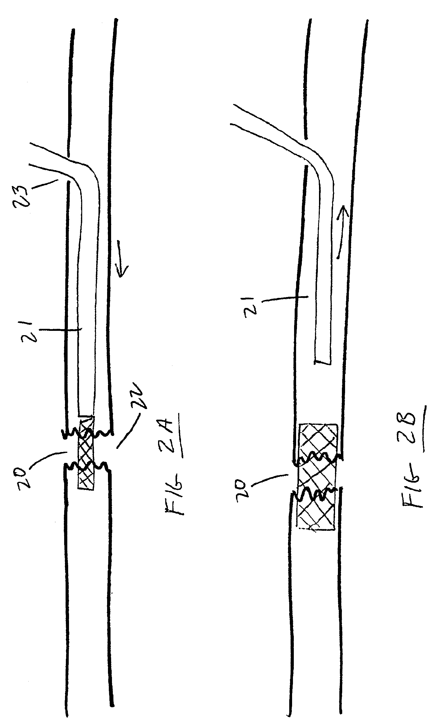 Methods and devices for treatment of bone fractures