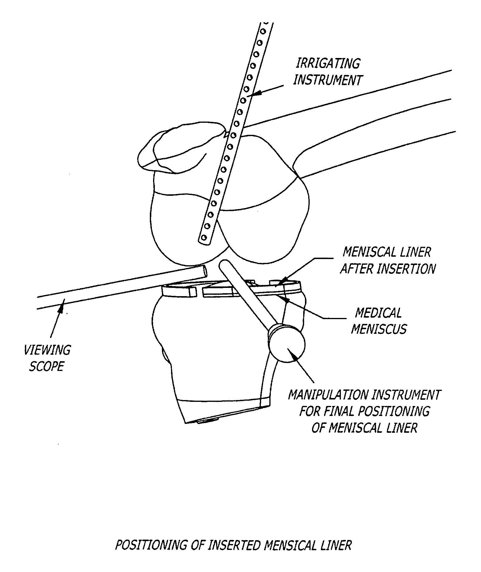 Knee joint prosthesis and hyaluronate compositions for treatment of osteoarthritis