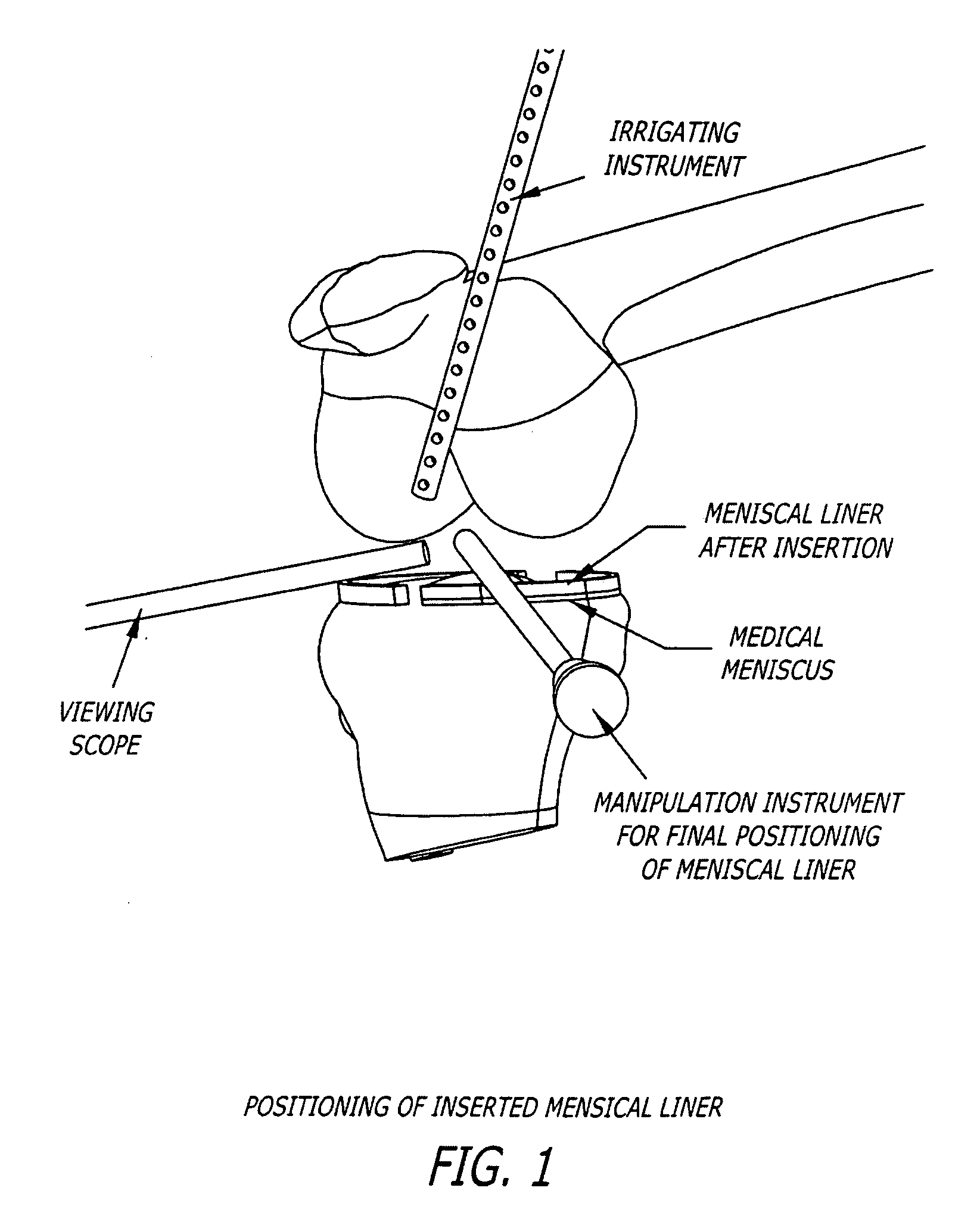 Knee joint prosthesis and hyaluronate compositions for treatment of osteoarthritis